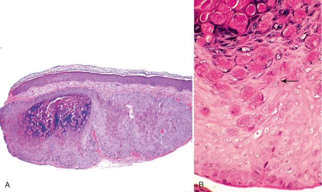 Fig. 4.11, A, Low-power photomicrograph of molluscum contagiosum illustrating the cup-shaped architecture. B, Higher power view of cytoplasmic inclusions, which become more distinct as a function of keratinocyte maturation (arrow) .