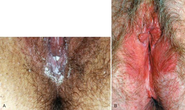 Fig. 4.4, A, Clinical presentation of candidiasis, with white curdlike deposits at the introitus. B, Erythema of the labia minora and majora, with satellitosis from candidiasis.