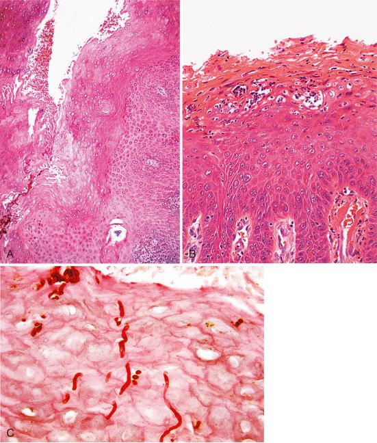 Fig. 4.5, A, Biopsy of candidiasis at low power, illustrating acanthosis. B, Superficial microabscess within the surface keratinocytes, containing acute inflammatory cells, should prompt a search for organisms. Note the resemblance to psoriasis. C, Pseudohyphae within the surface keratotic layer.