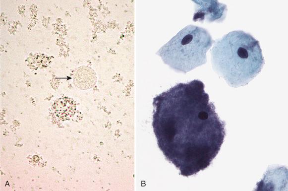 Fig. 4.6, Bacterial vaginosis, seen as dense, evenly distributed collections of bacterial rodlike forms in the squamous cells as seen on a wet prep (A) or Papanicolaou stain (clue cells; B ).