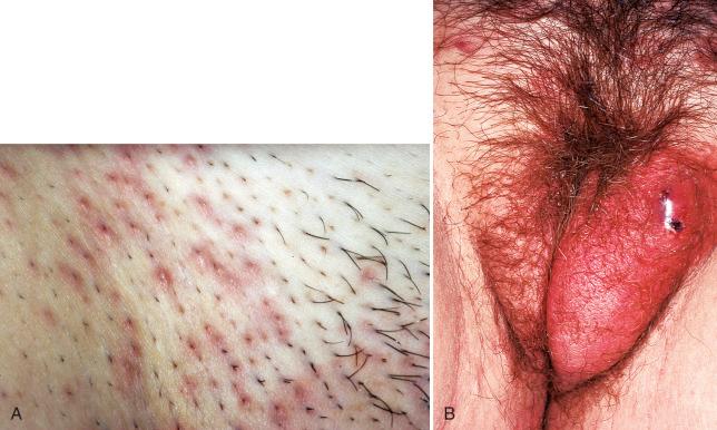 Fig. 4.7, Clinical picture of folliculitis. A, Punctate perifollicular inflammation following shaving. B, Diffuse induration produced by dermal follicular inflammation.