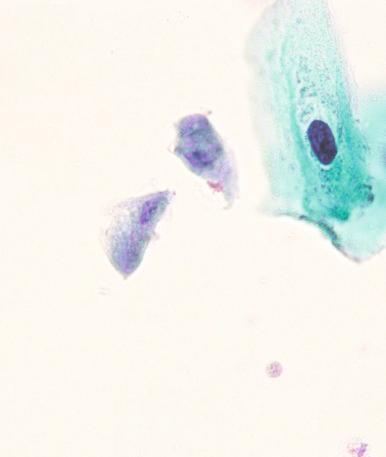 Fig. 4.9, Pap smear showing two organisms of Trichomonas vaginalis exhibiting a characteristic indistinct ghostly appearance, with an oval nucleus and faint red granules.