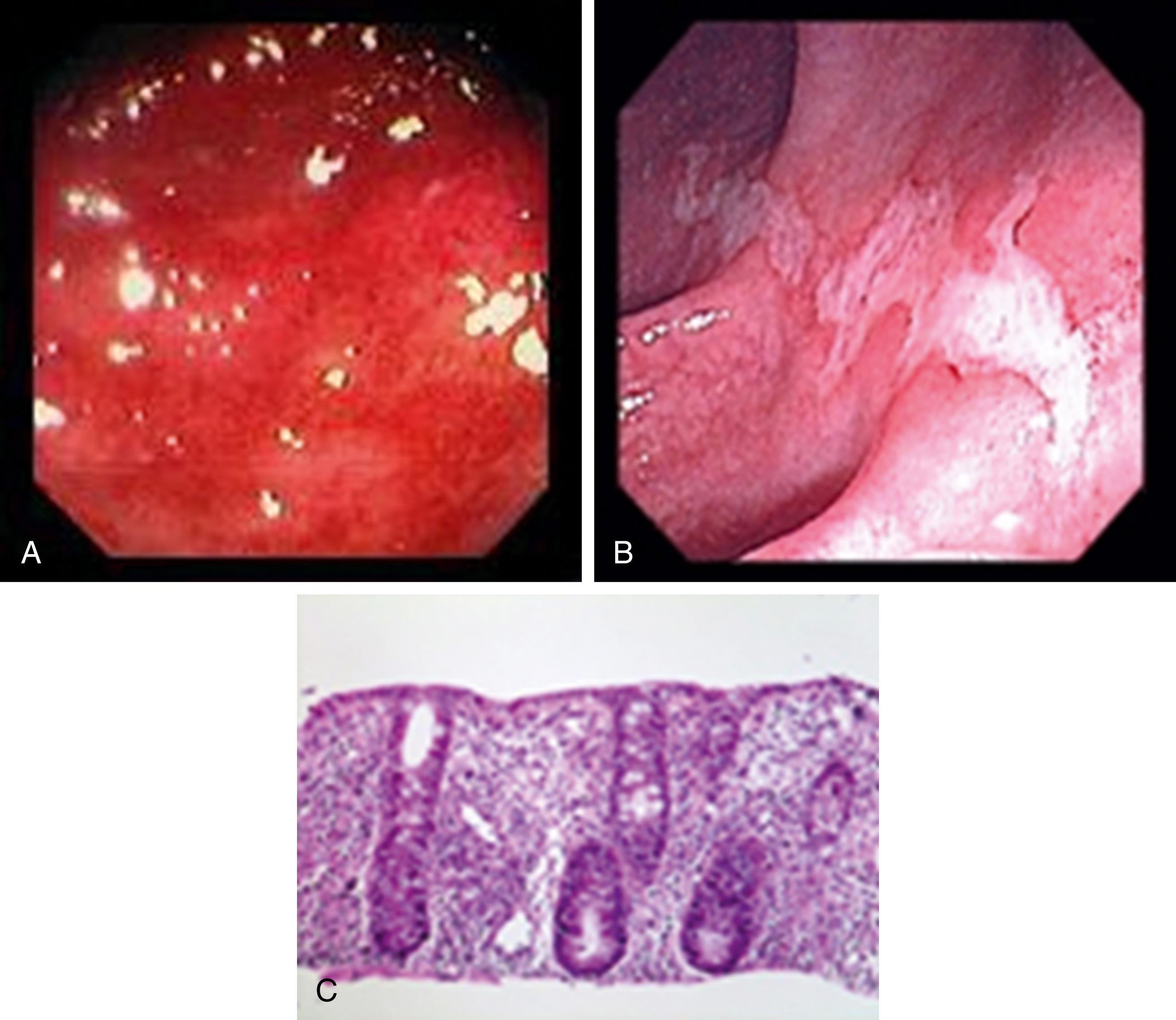 Fig. 110.3, Sigmoidoscopy and histopathology of acute self-limited infectious colitis. A , a 24-year-old with bloody diarrhea in whom sigmoidoscopy revealed mucosal inflammation with erythema, edema, granularity, and loss of the normal vascular pattern. Stool culture grew Salmonella. The gross appearance resembles that of UC. B , a 58-year-old woman with bloody diarrhea in whom colonoscopy revealed mucosal inflammation with large, flat ulcers in the ascending colon. Stool culture grew Campylobacter jejunii . C , Histopathology of acute self-limited colitis, the cause of which could have been Campylobacter , Salmonella , or any one of a number of other bacteria. The presence of inflammatory cells throughout the lamina propria and straight glands without architectural distortion or branching is typical of acute colitis and helps to differentiate acute from chronic colitis.