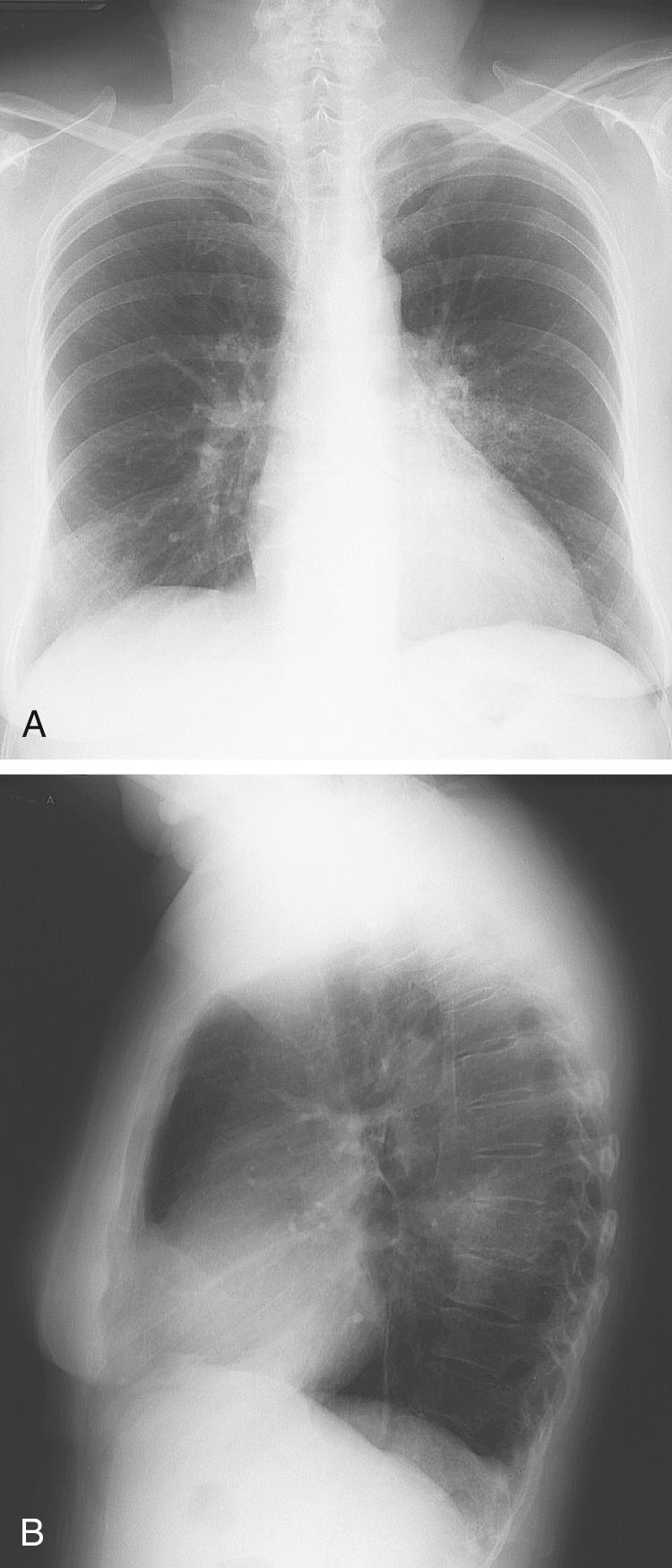 FIGURE 12-1, Posteroanterior (A) and lateral (B) chest radiographs demonstrating segmental pneumonia involving the superior segment of the left lower lobe.