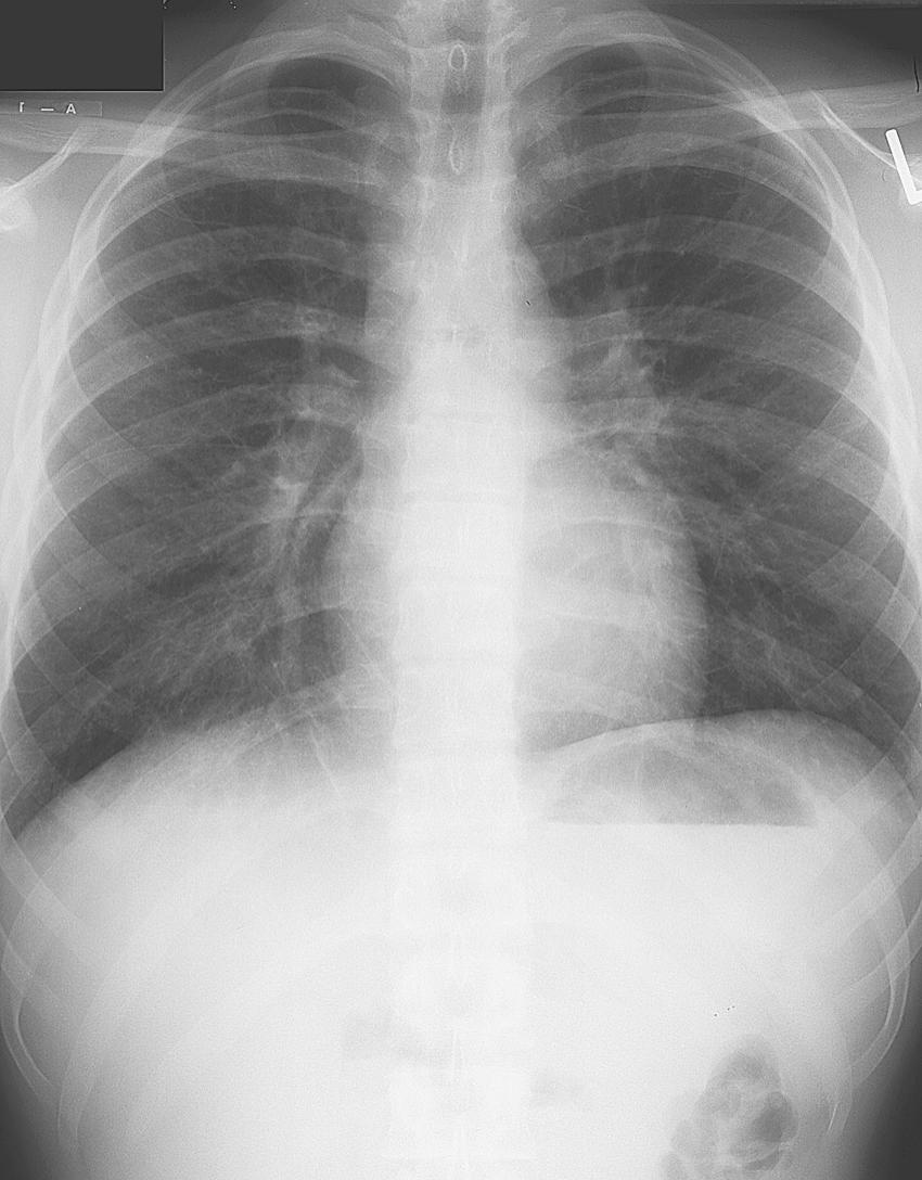 FIGURE 12-2, Posteroanterior chest radiograph demonstrating a fine interstitial pattern indicative of Mycoplasma pneumoniae.