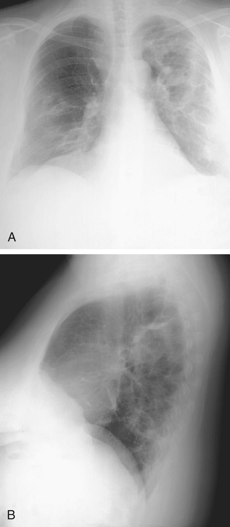 FIGURE 12-3, Posteroanterior (A) and lateral (B) chest radiographs demonstrating diffuse infiltrates with cavitation, radiographic features of Legionella infection.