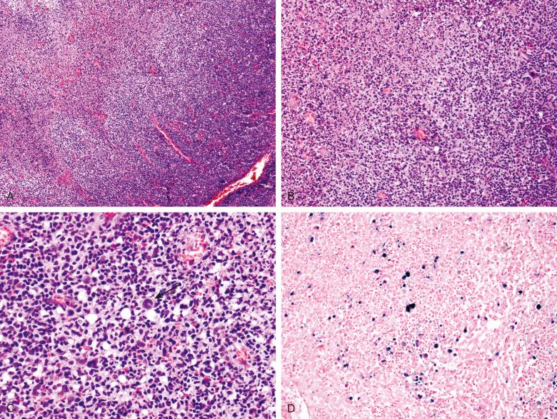 Figure 12.1, Infectious mononucleosis, tonsil.