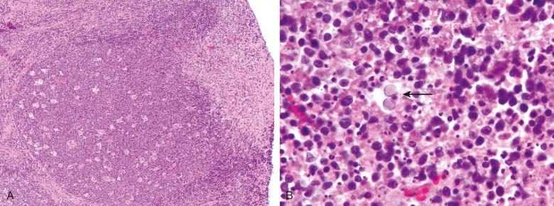 Figure 12.2, Herpes simplex lymphadenitis.