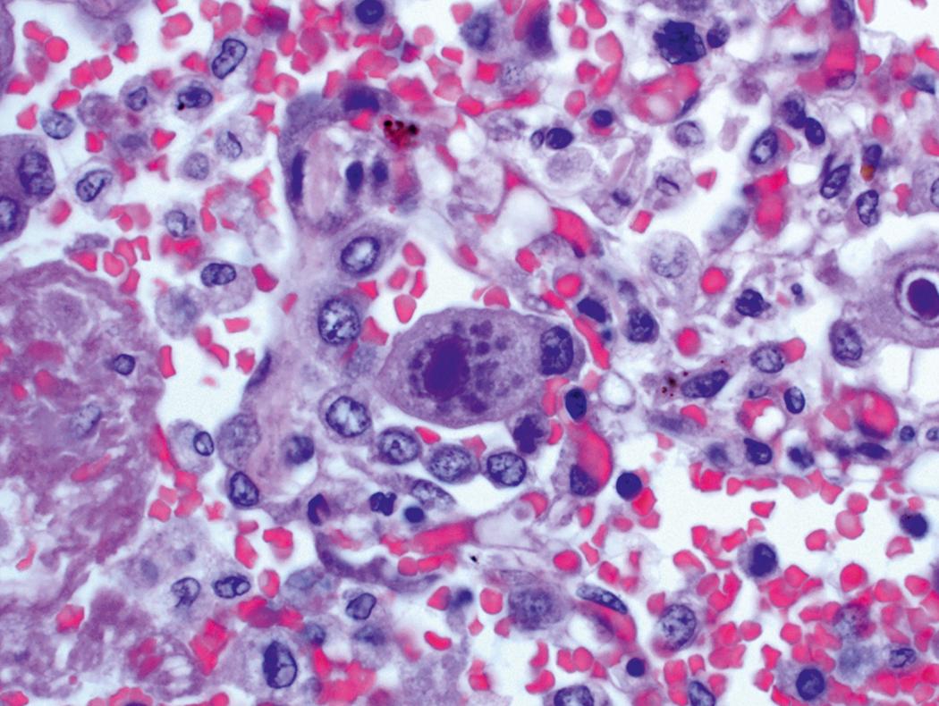 Fig. 17.1, A cell infected by cytomegalovirus has a large basophilic intranuclear inclusion with a clear halo and smaller cytoplasmic inclusions (histologic section, hematoxylin-eosin stain).