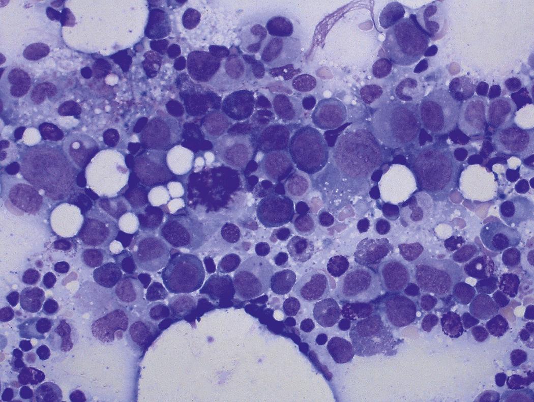 Fig. 17.2, Human parvovirus B19 causes the formation of giant pronormoblasts (bone marrow aspirate smear, Giemsa stain).