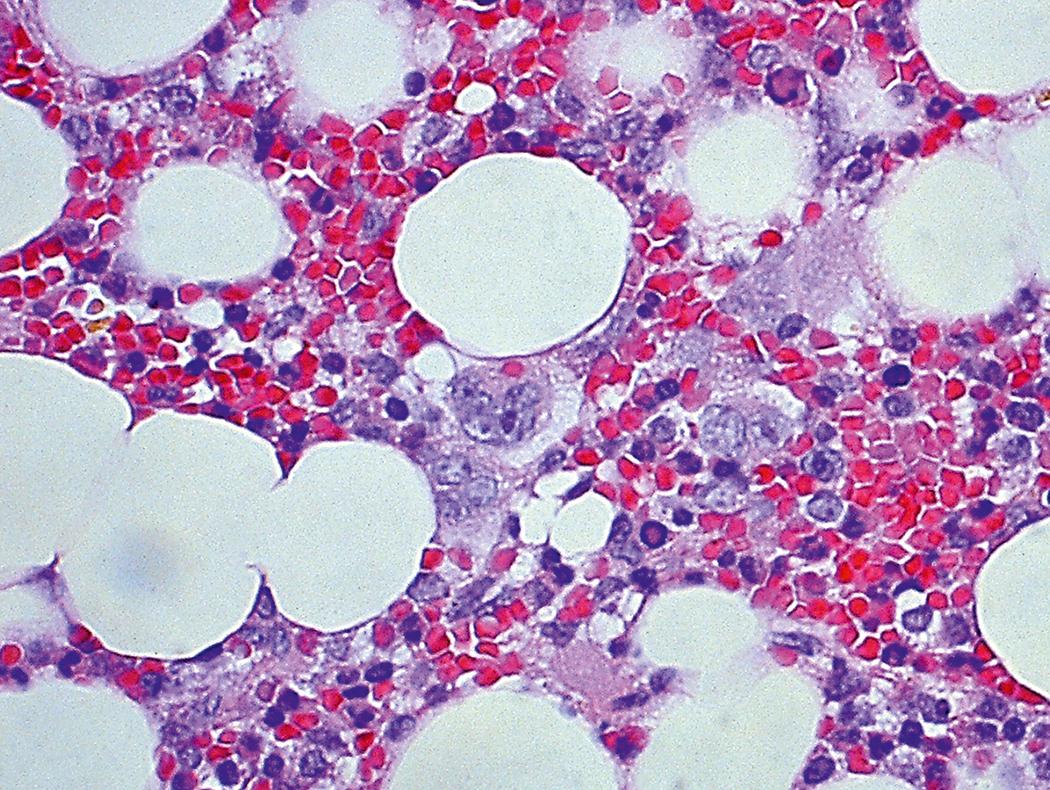 Fig. 17.3, Human parvovirus B19 causes the formation of giant pronormoblasts (bone marrow biopsy specimen, hematoxylin-eosin stain).