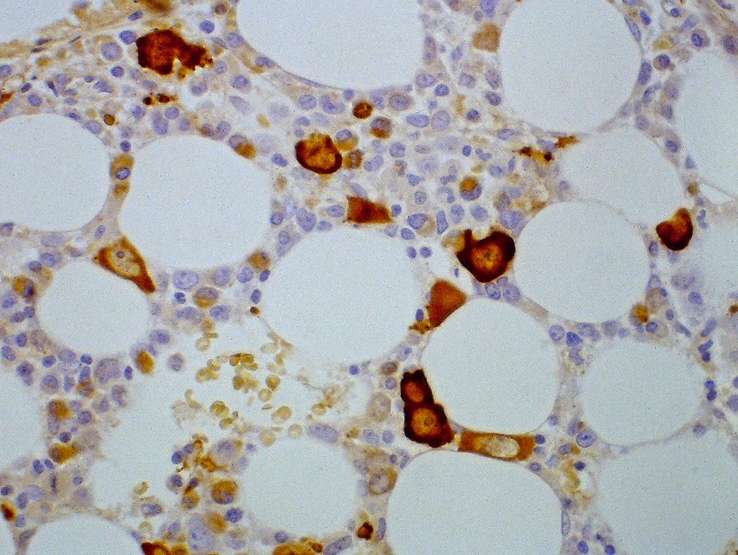 Fig. 17.4, The immunohistochemical stain for hemoglobin highlights red blood cell precursors, including these giant pronormoblasts in a bone marrow biopsy from a patient with human parvovirus B19 infection.