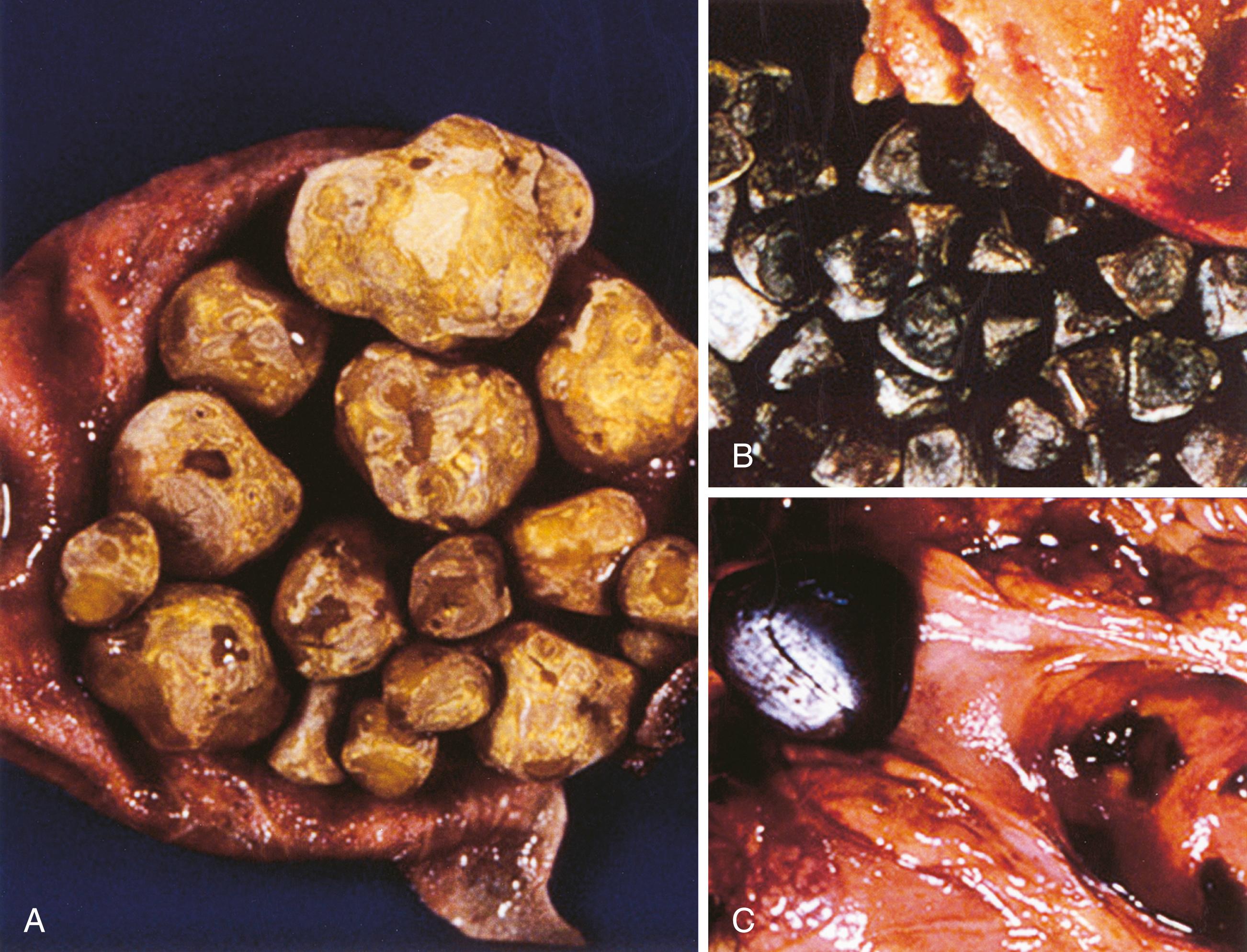 FIGURE 38.1, Cholesterol gallstones (A), black stones (B), and brown stones (C) within bile ducts.