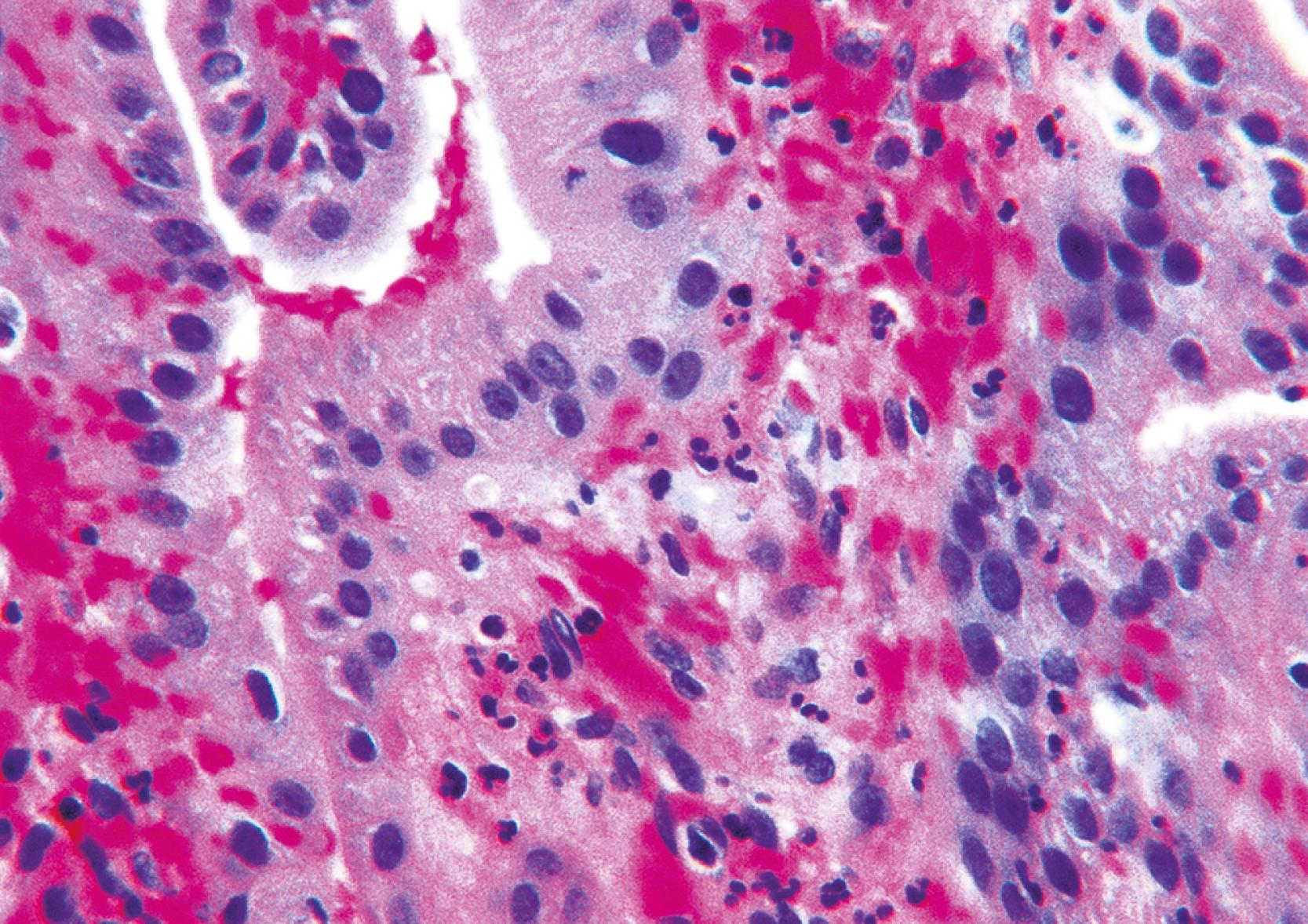 FIGURE 38.3, In the early phases of acute cholecystitis, neutrophils predominate, and the lamina propria is frequently hemorrhagic.