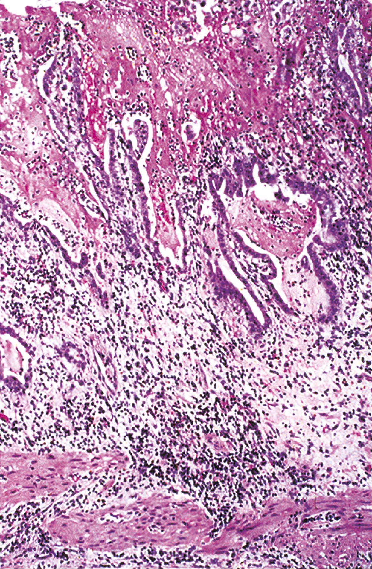 FIGURE 38.4, In acute pseudomembranous cholecystitis, thick, fibrinous pseudomembranes are firmly attached to necrotic biliary epithelium and appear to merge with the underlying edematous and inflamed lamina propria.