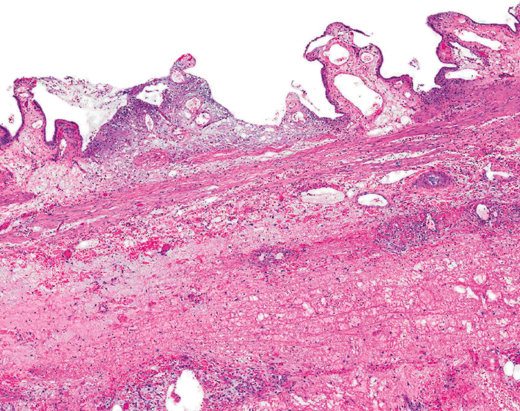 FIGURE 38.6, Acute acalculous cholecystitis is characterized by edema of the lamina propria, focal necrosis of the biliary epithelium, and lymphatic dilation. The muscularis is not thickened. The inflammatory process involves the pericystic tissues.