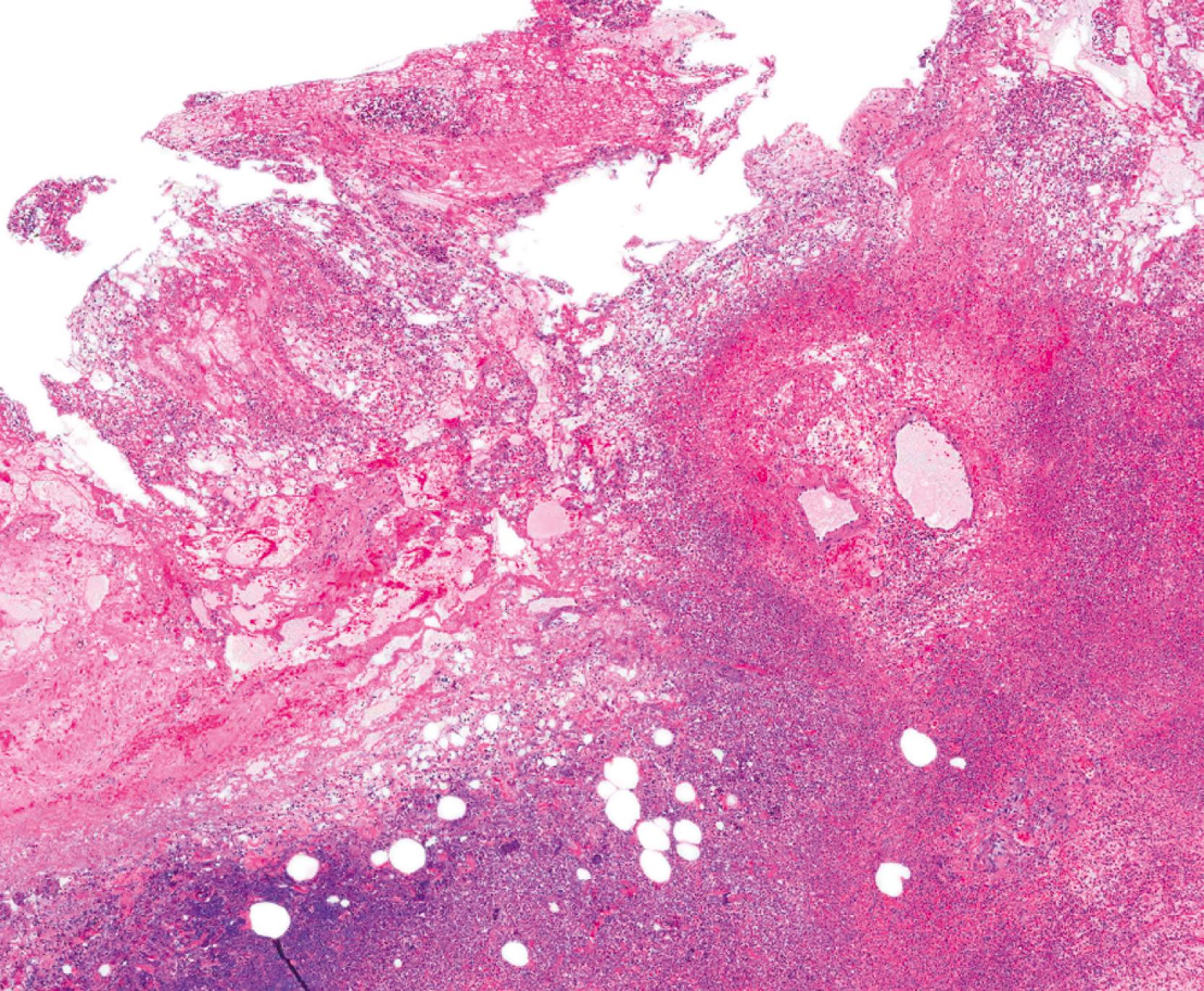 FIGURE 38.7, In acute emphysematous cholecystitis, transmural necrosis and inflammation are apparent. The empty spaces represent gas bubbles.