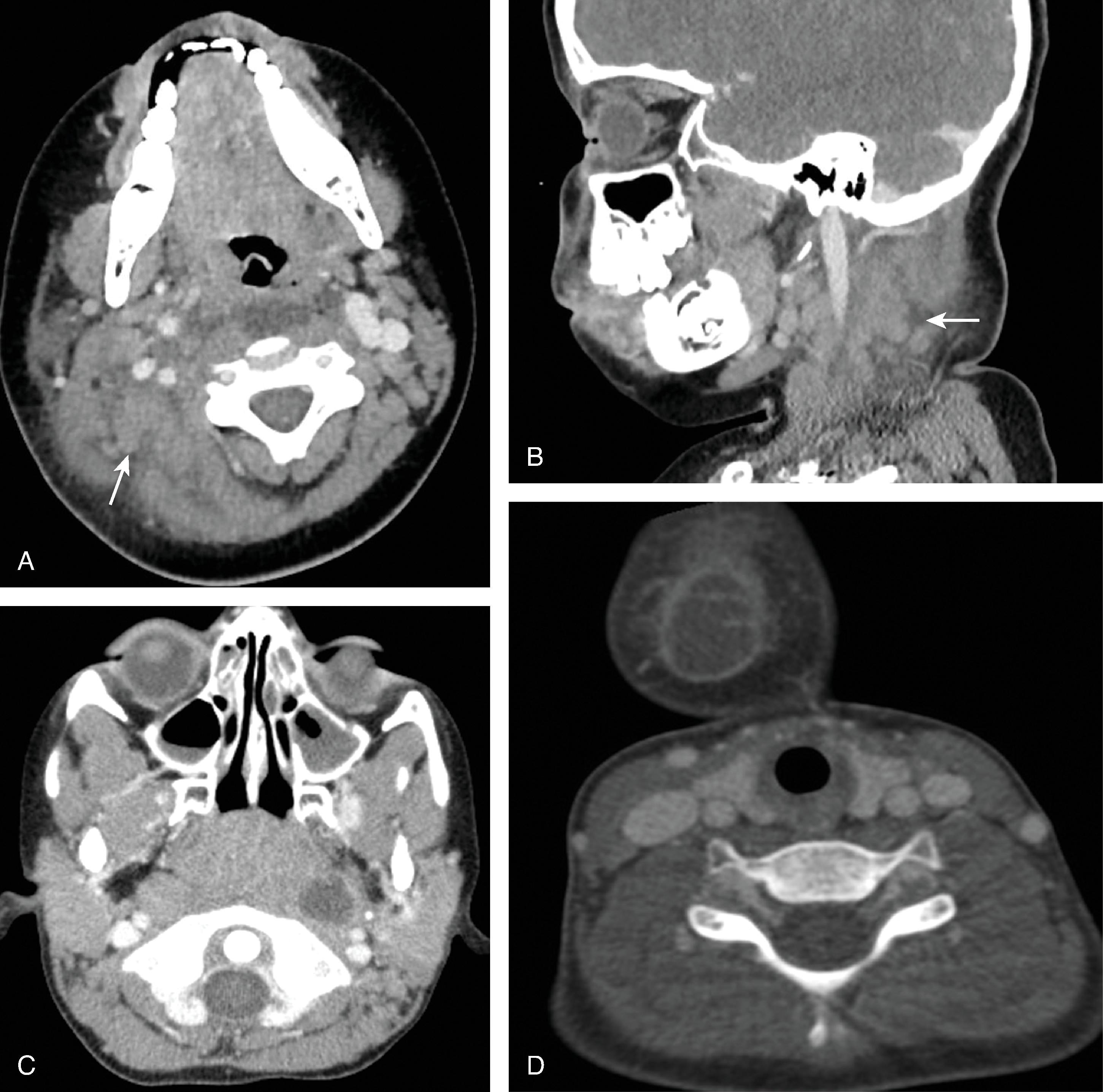 Fig. 15.1, Lymphadenitis and Suppurative Lymph Nodes.