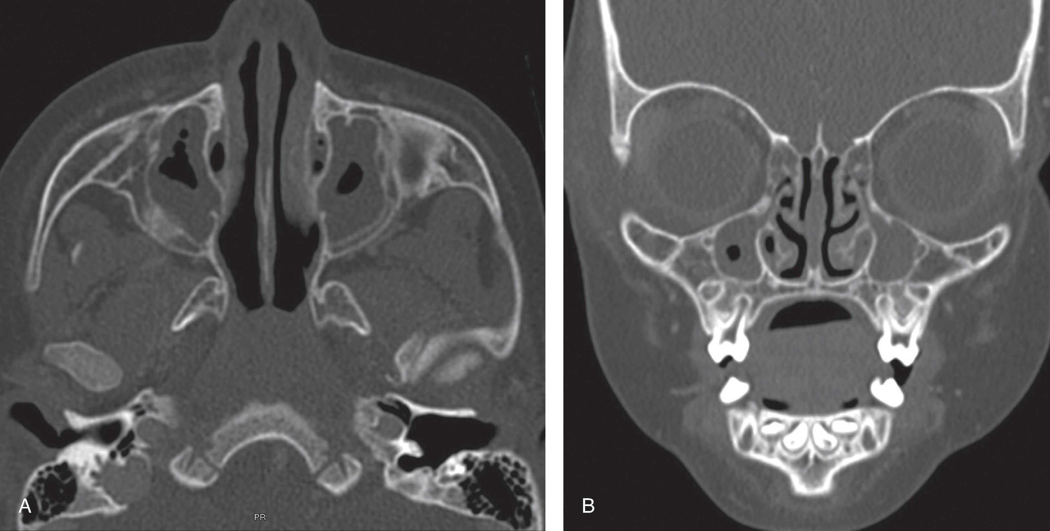 Fig. 15.12, Paranasal Sinusitis.