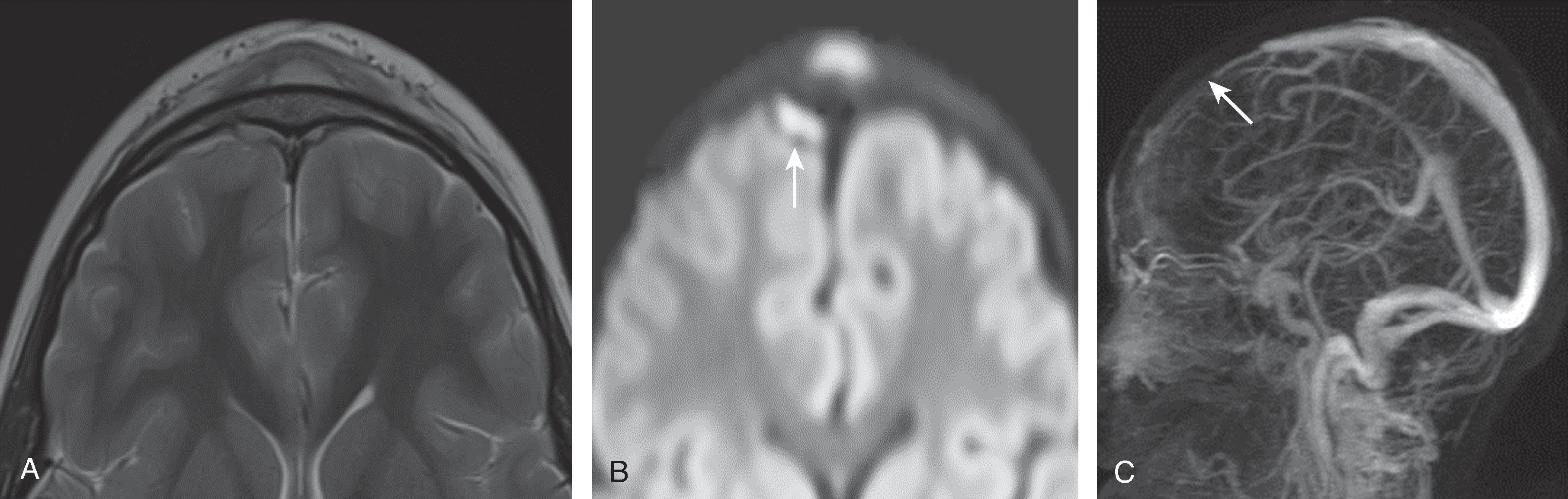 Fig. 15.13, Sinusitis Complications: Pott’s Puffy Tumor, Empyema, and Sinus Thrombosis.