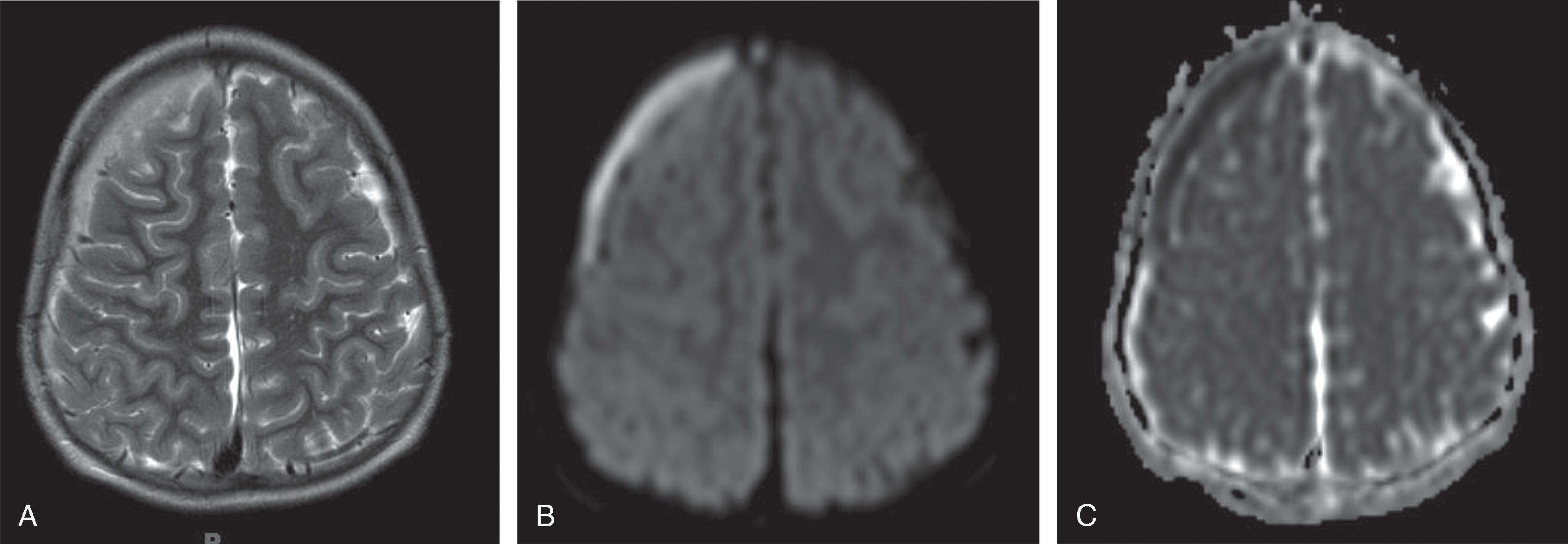 Fig. 15.14, Sinusitis Complications: Subdural Empyema.