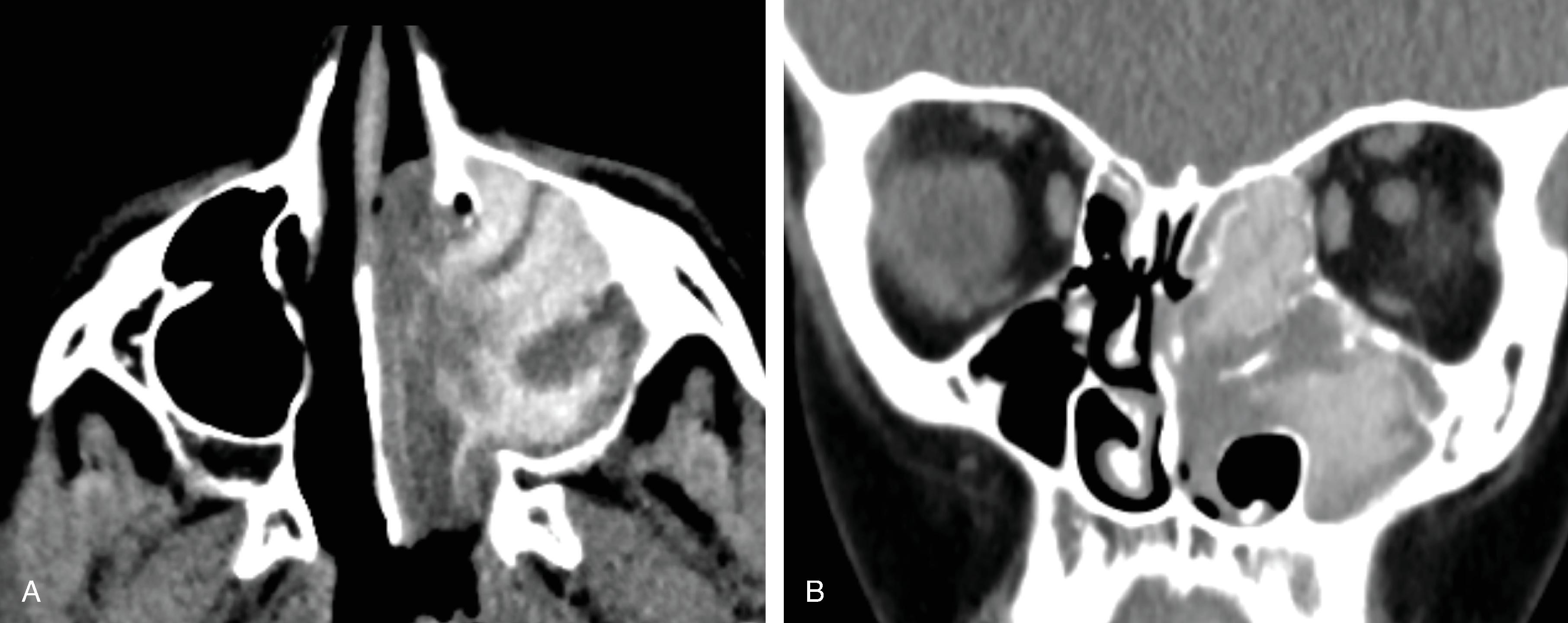 Fig. 15.15, (A and B) Axial and coronal noncontrast CT images demonstrate abnormal opacification of the left maxillary and ethmoid sinuses with centrally hyperdense, peripherally hypodense sinus secretions, sinus expansion, and sinus drainage pathway obstruction.