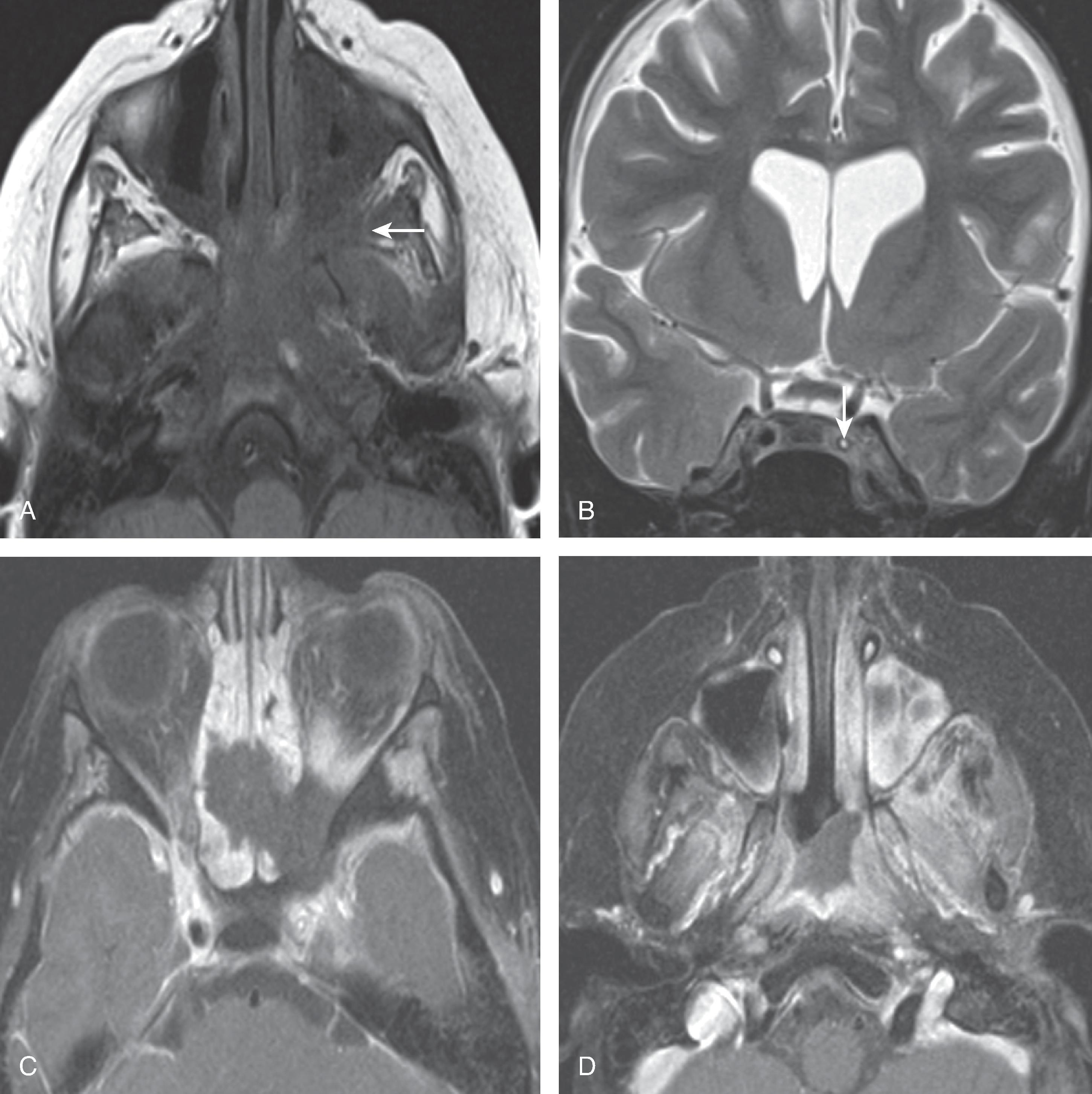 Fig. 15.16, Invasive Fungal Sinusitis.