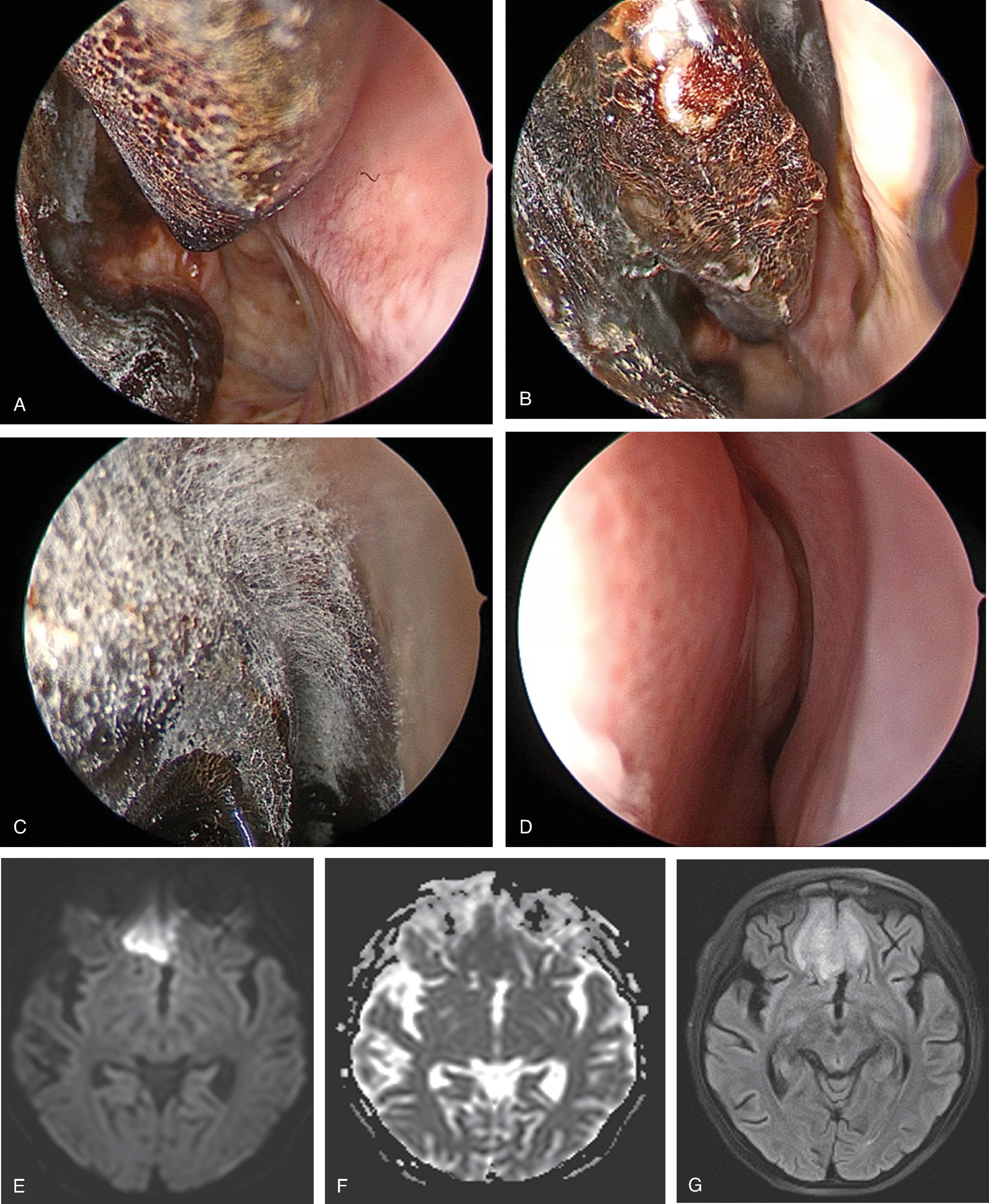 Fig. 15.17, Invasive Fungal Sinusitis.