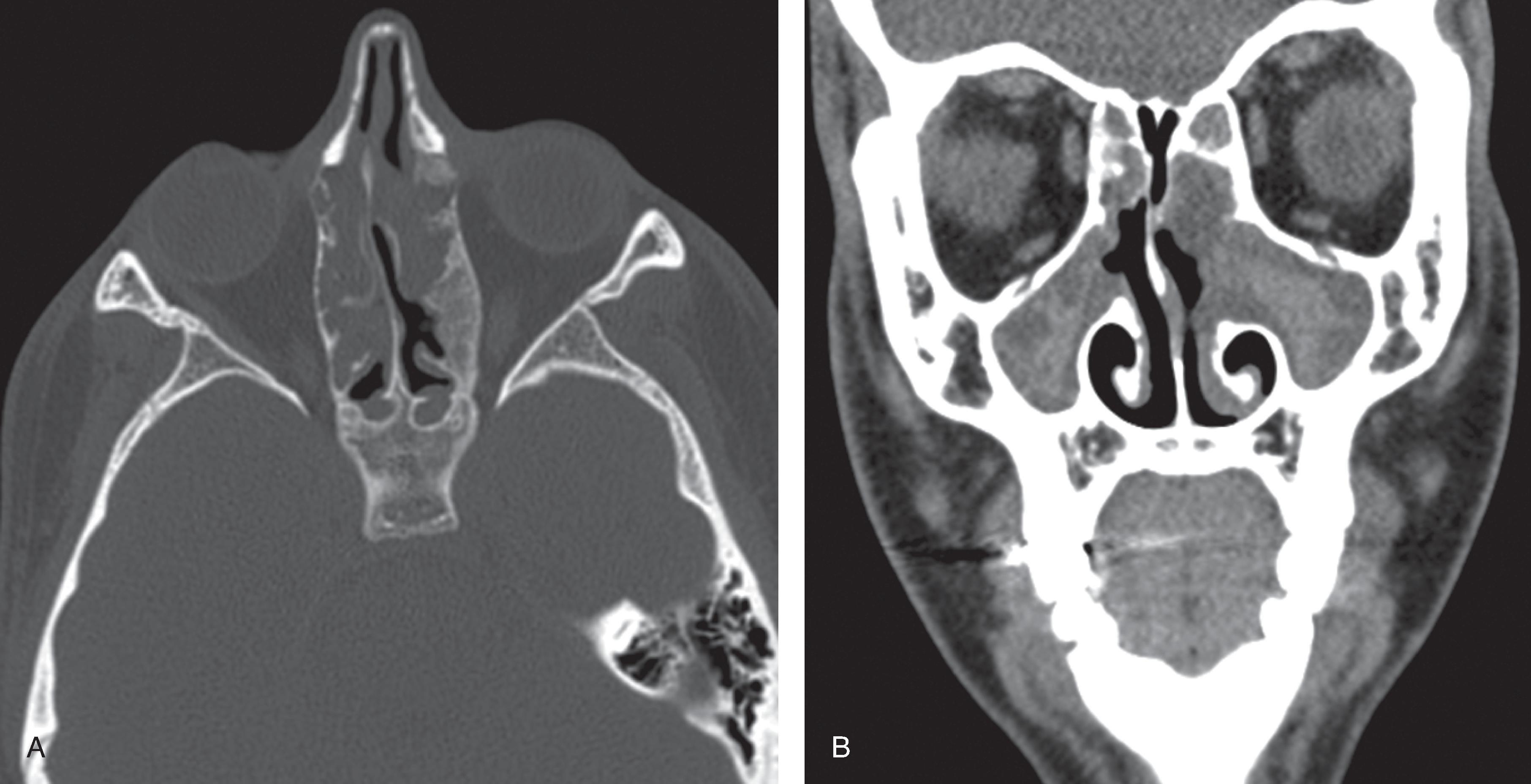 Fig. 15.18, Cystic Fibrosis.