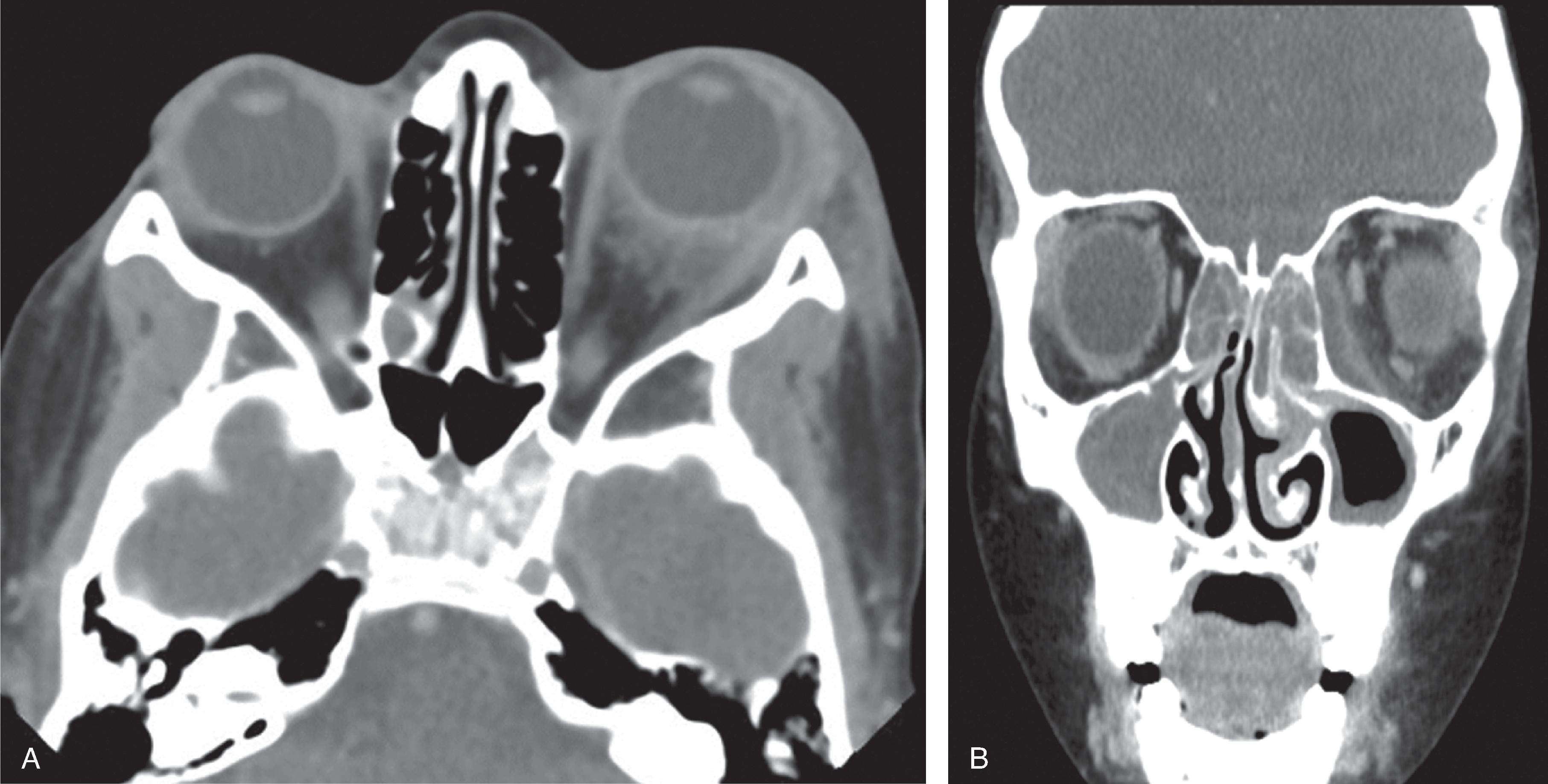 Fig. 15.19, Orbital Cellulitis.