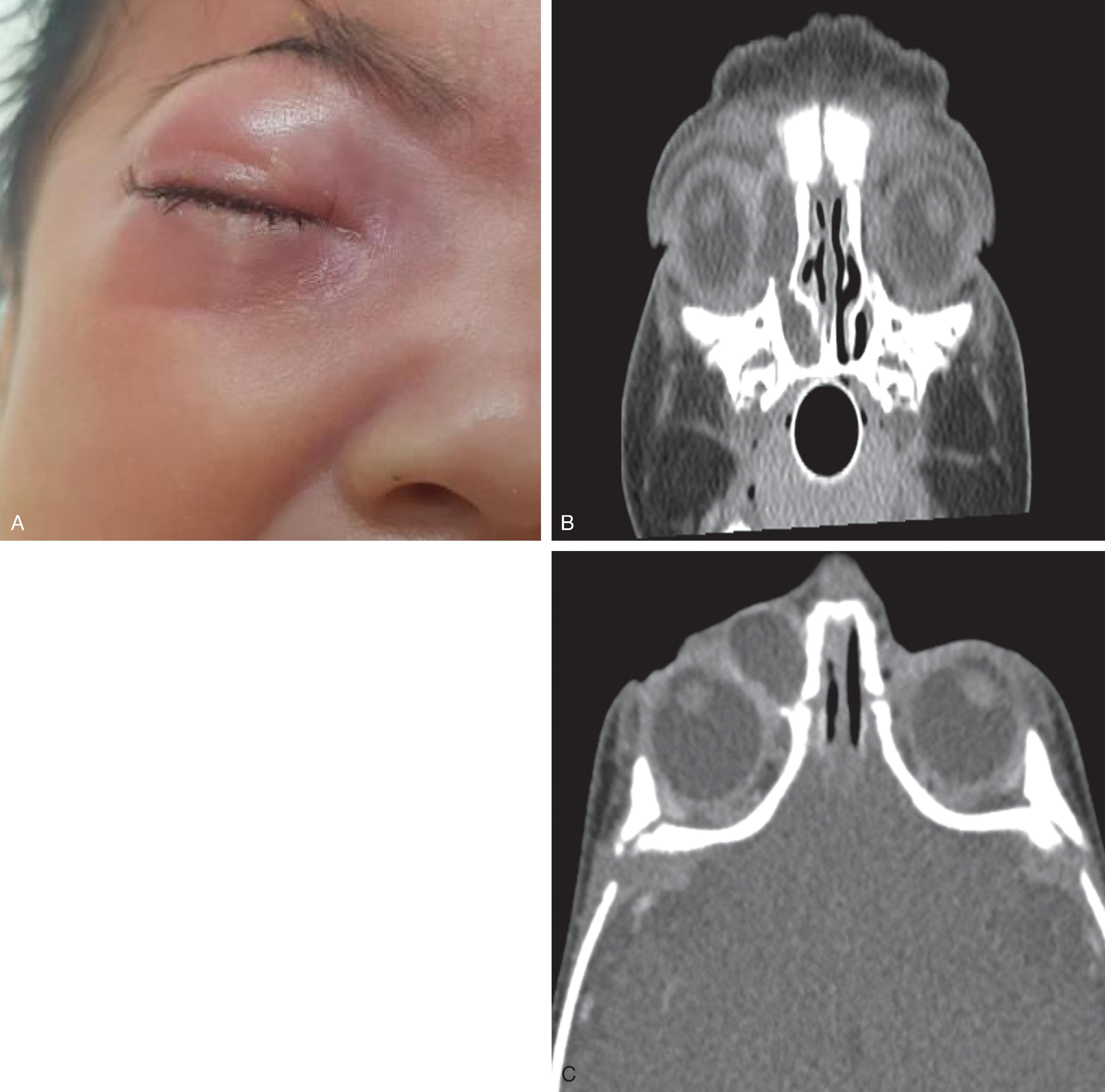 Fig. 15.20, Dacryocystitis.