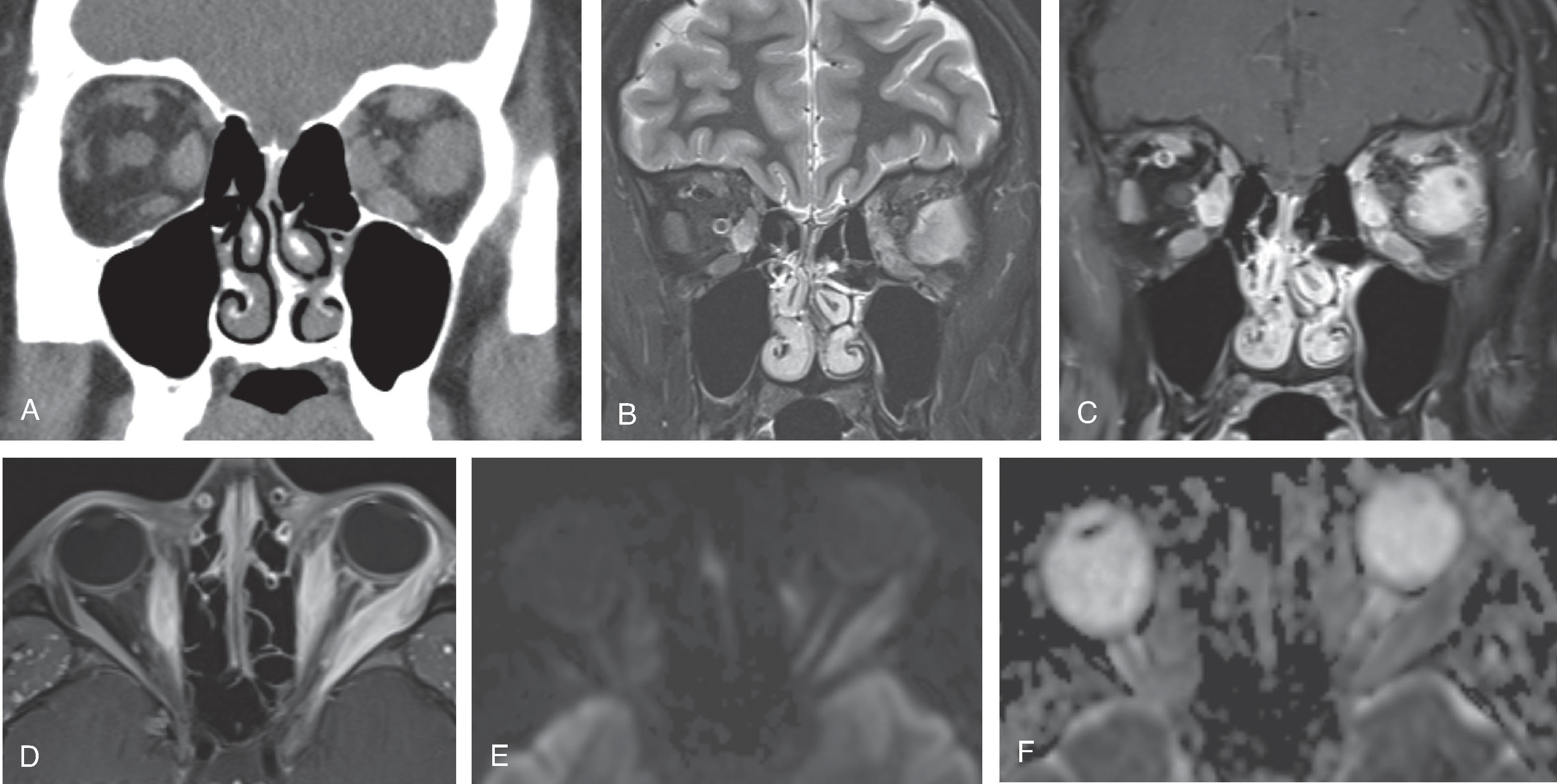 Fig. 15.21, Orbital Pseudotumor.