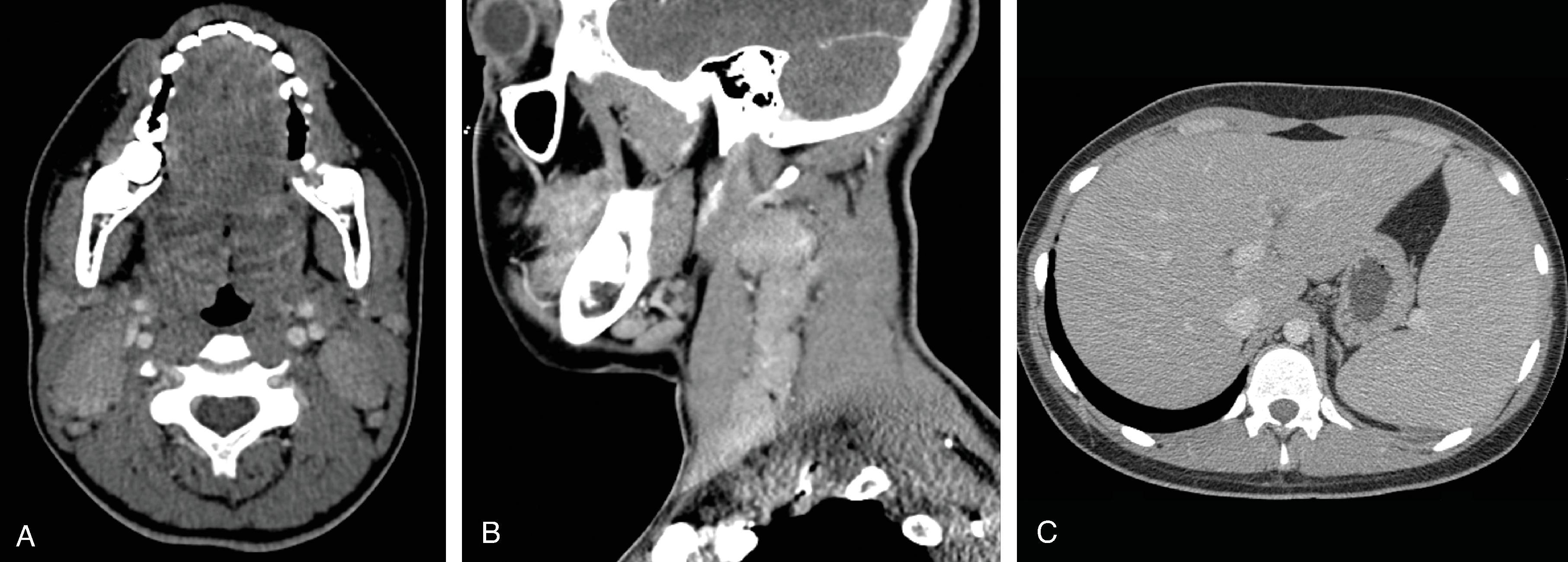 Fig. 15.2, Infectious Mononucleosis.