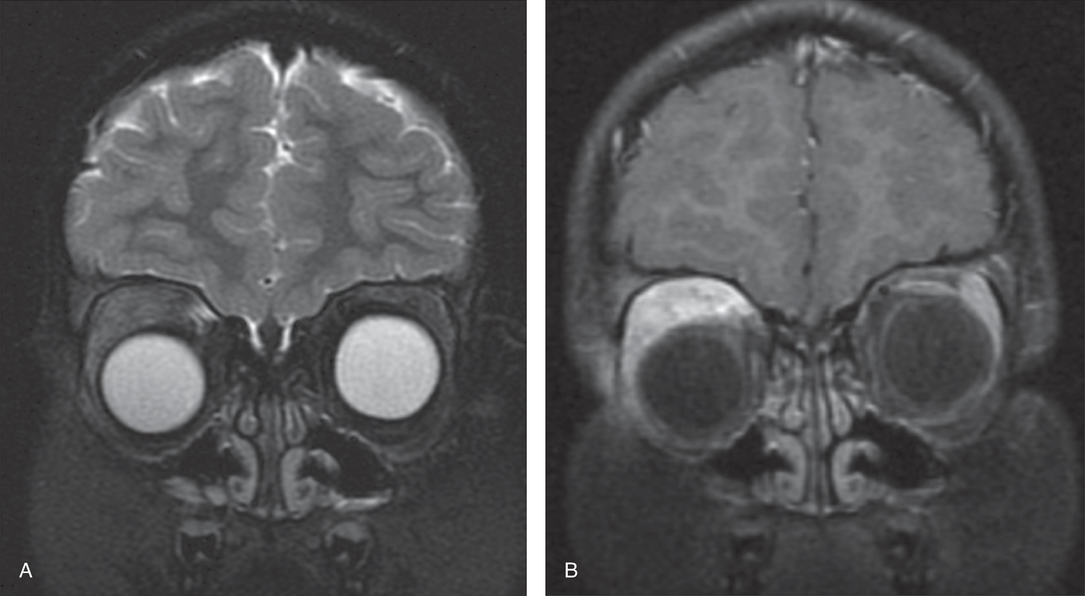 Fig. 15.22, Orbital Pseudotumor.