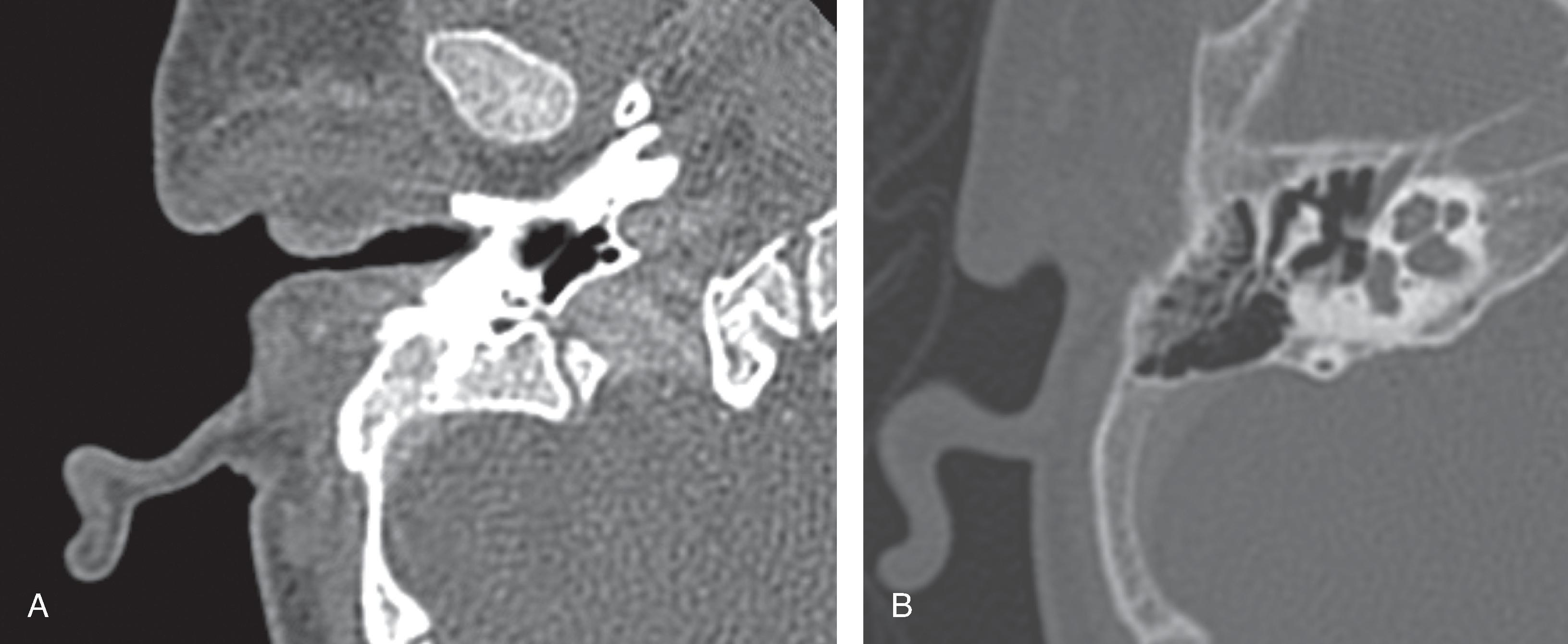 Fig. 15.26, Acute Otitis Externa.