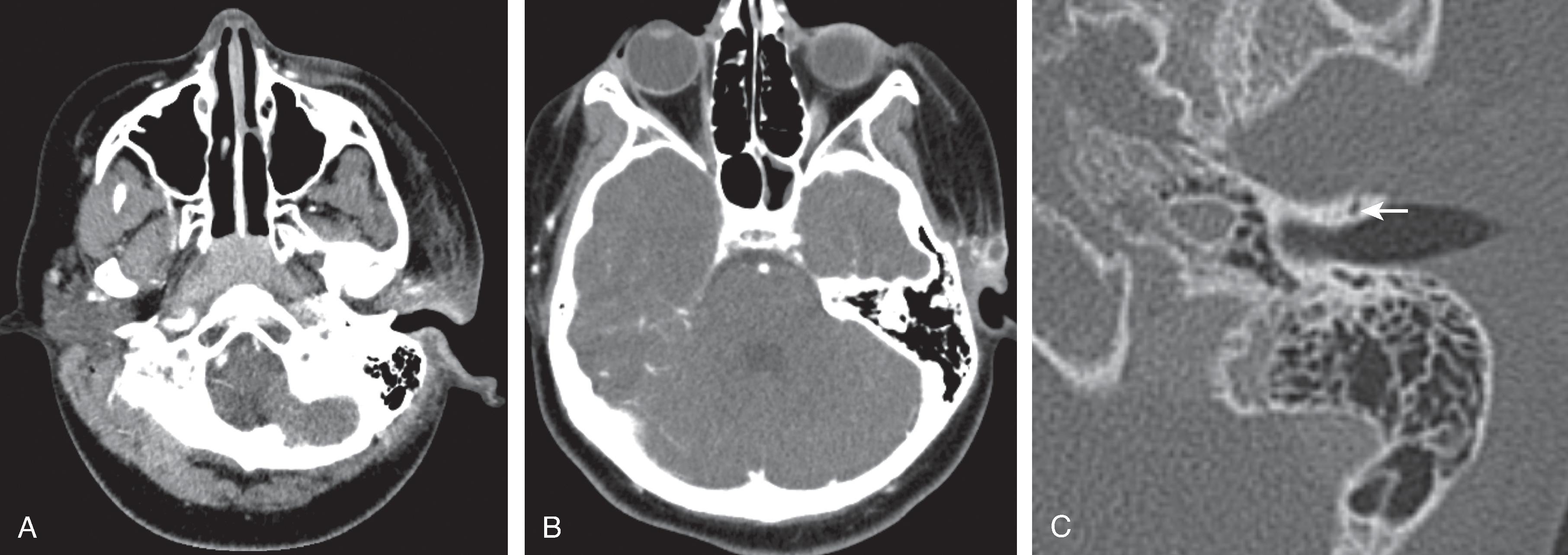 Fig. 15.27, Acute Otitis Externa Secondary to a First Branchial Cleft Fistula.