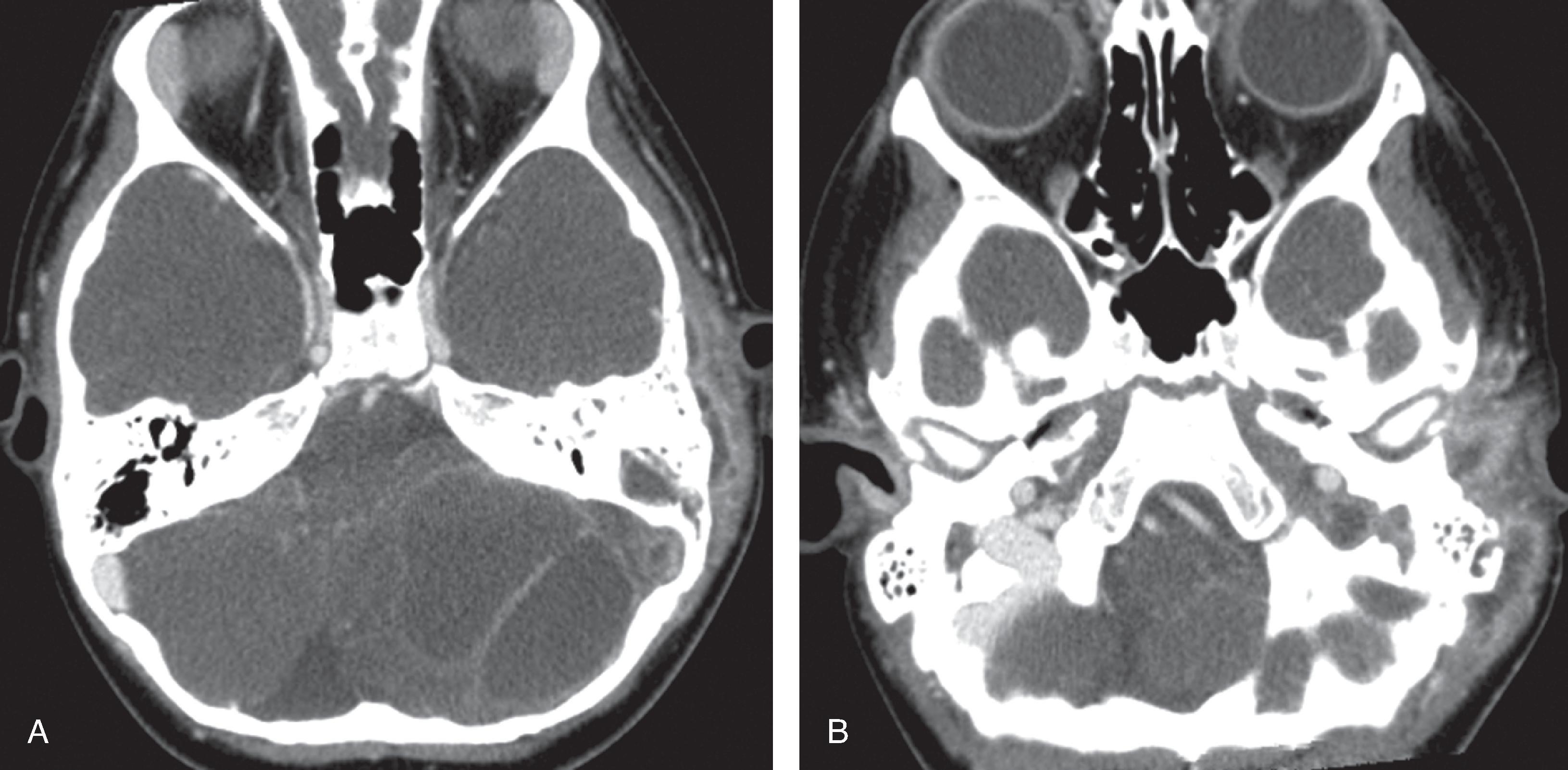 Fig. 15.29, Acute Mastoiditis With Intracranial Abscess and Sinus Thrombosis.