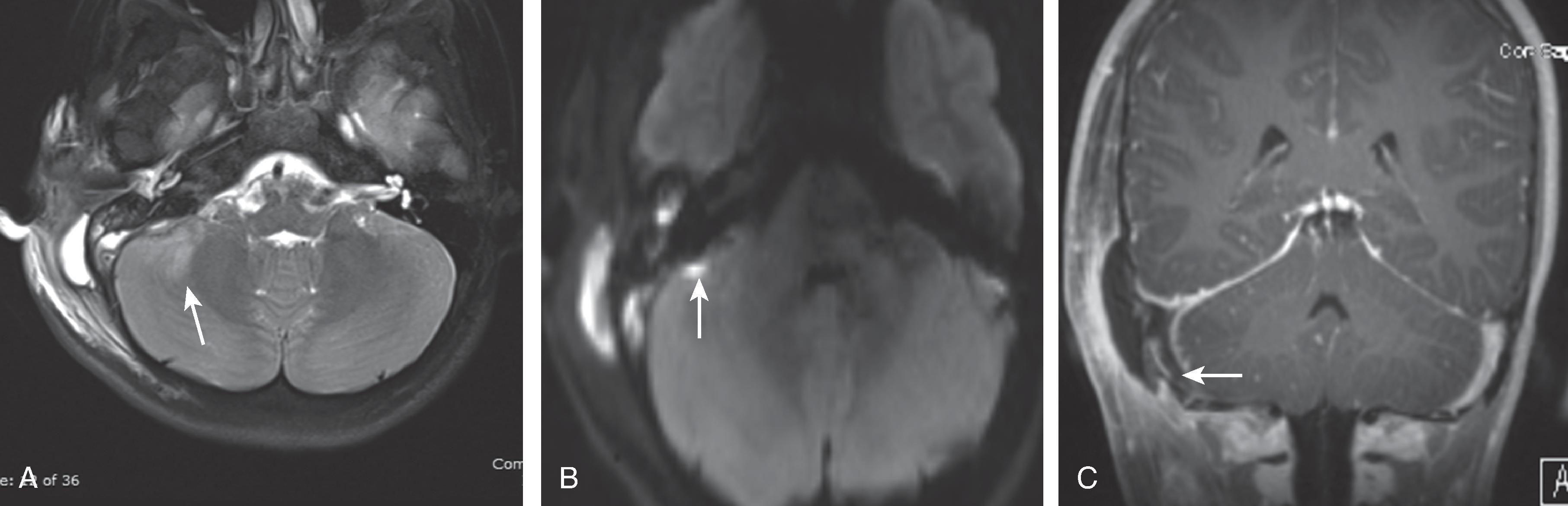 Fig. 15.30, Acute Mastoiditis With Intracranial Empyema, Cerebritis, Meningitis and Sinus Thrombosis.