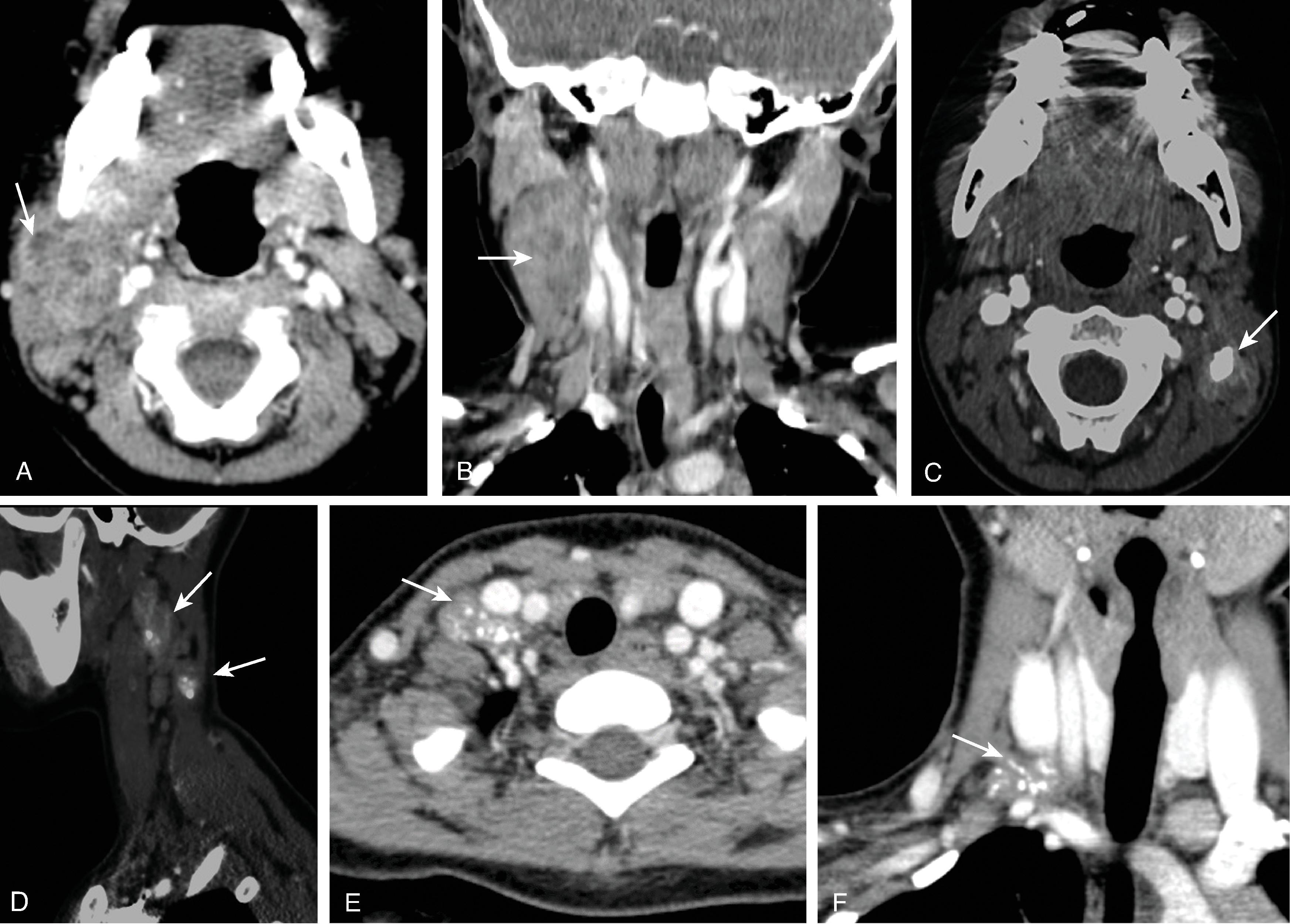 Fig. 15.3, Granulomatous Infection.