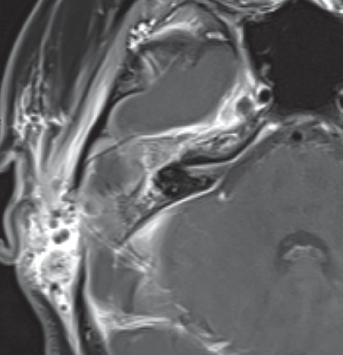 Fig. 15.32, 14-Year-Old With Petrous Apicitis Secondary to Acute Otomastoiditis.
