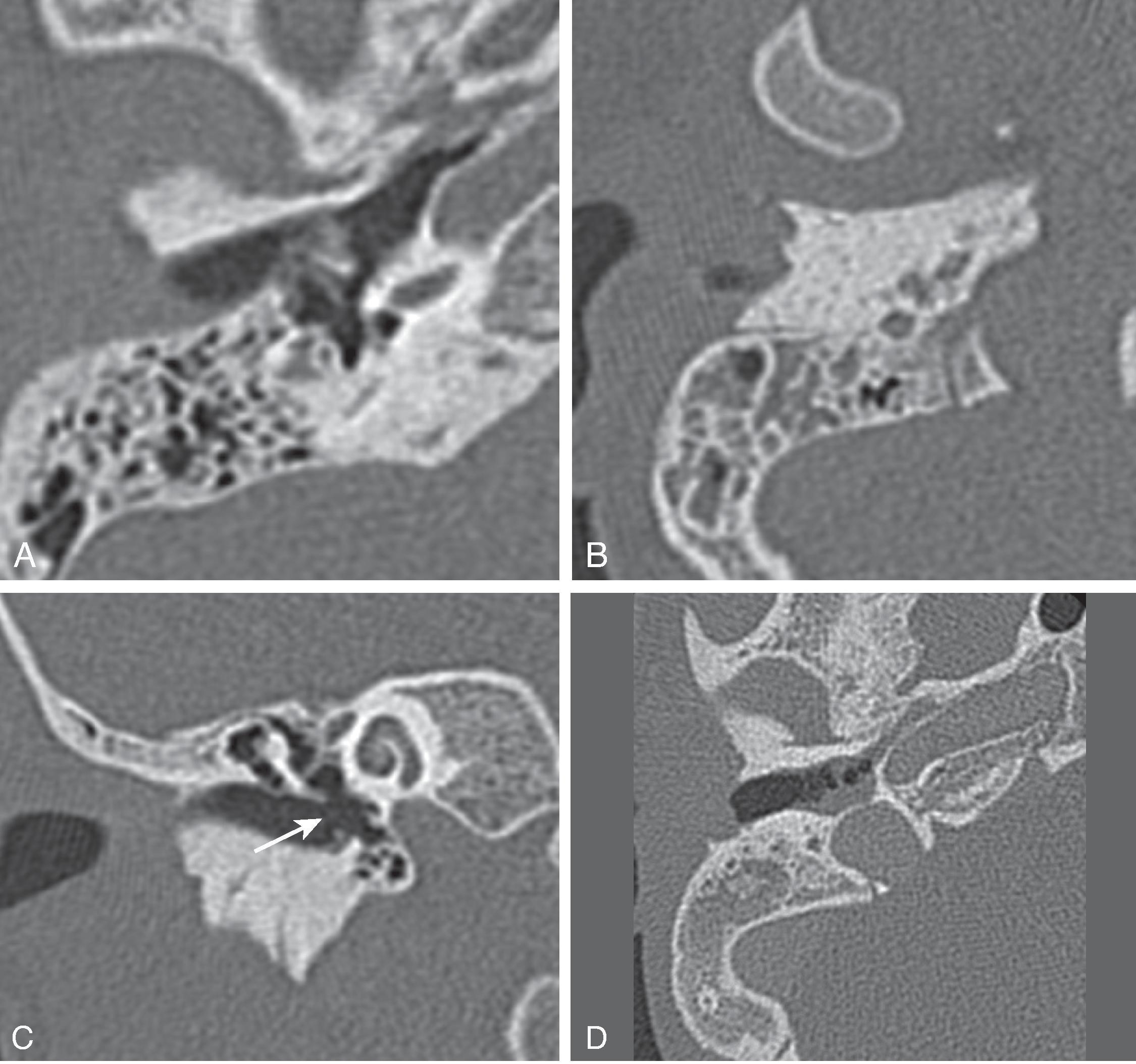 Fig. 15.33, Chronic Otitis Media.