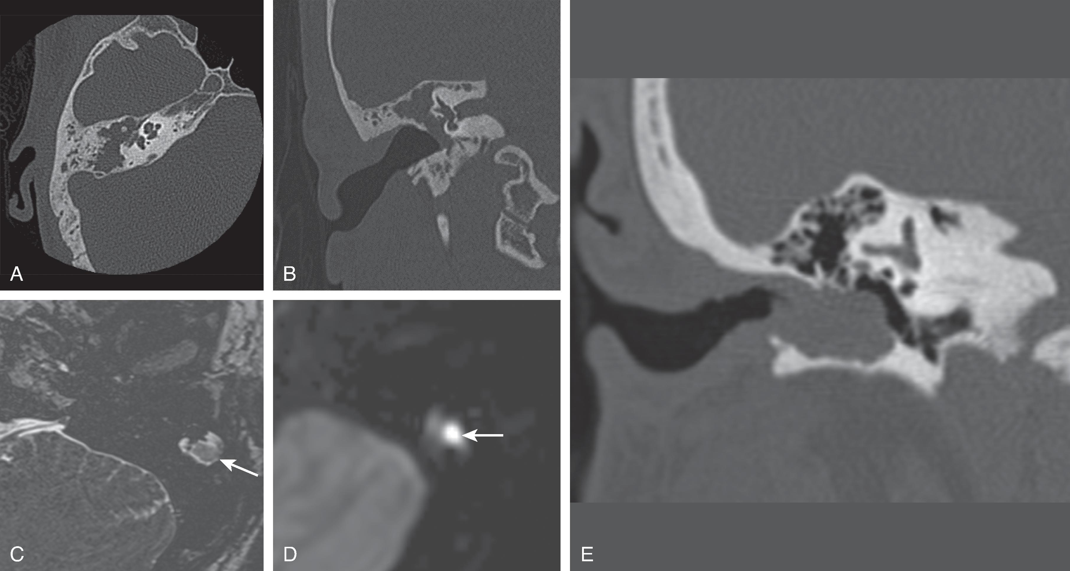 Fig. 15.34, Acquired Cholesteatoma.