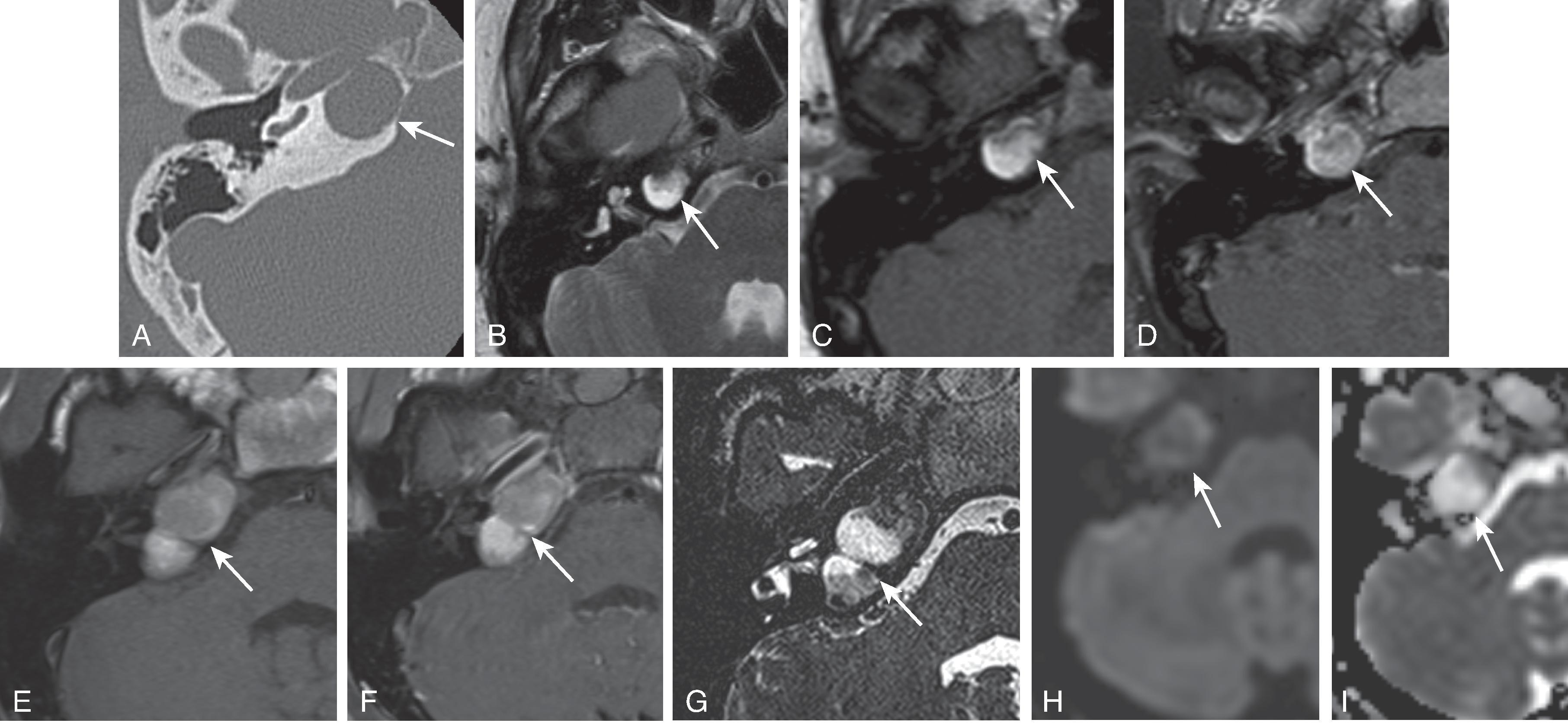 Fig. 15.35, Cholesterol Granuloma.