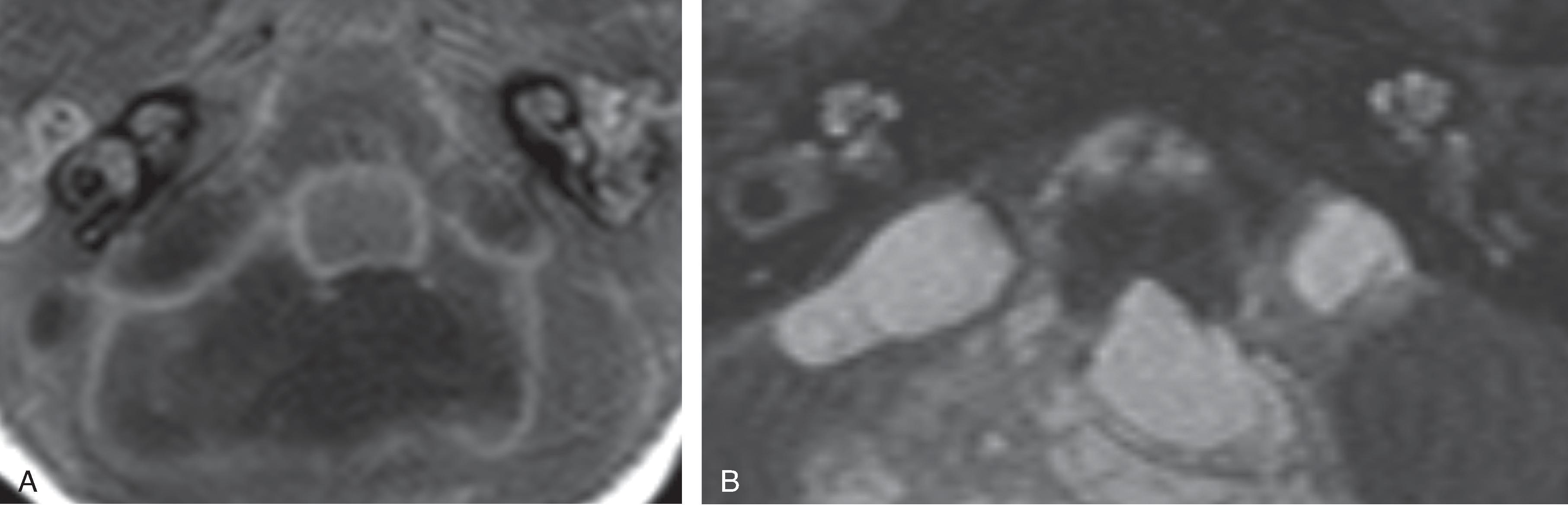 Fig. 15.36, Labyrinthitis Ossificans.