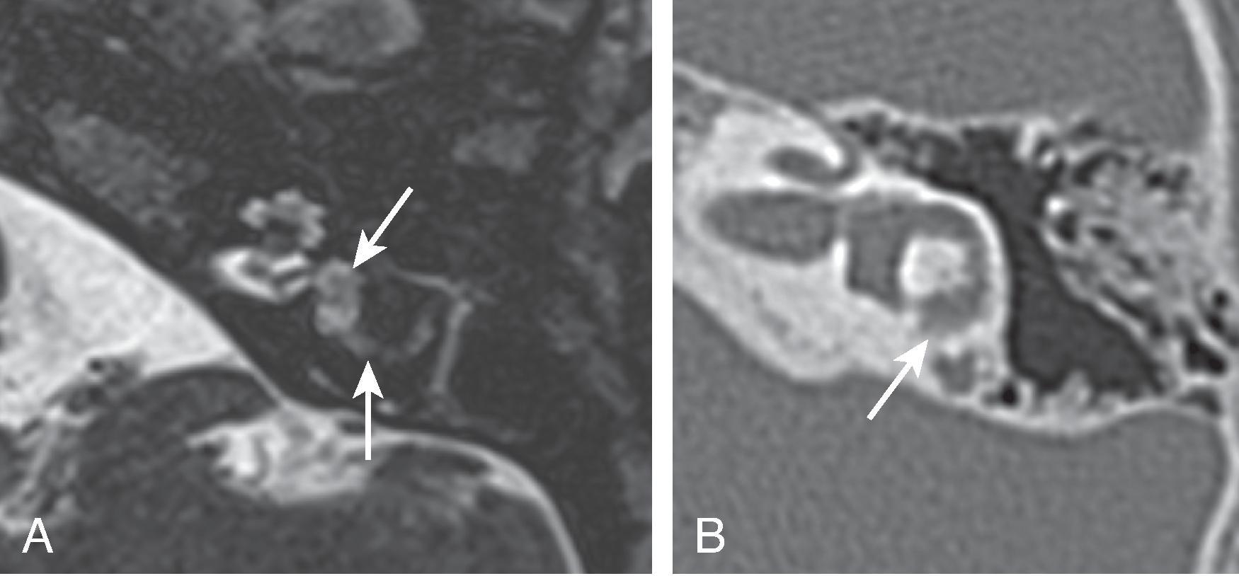 Fig. 15.37, Labyrinthitis Ossificans.