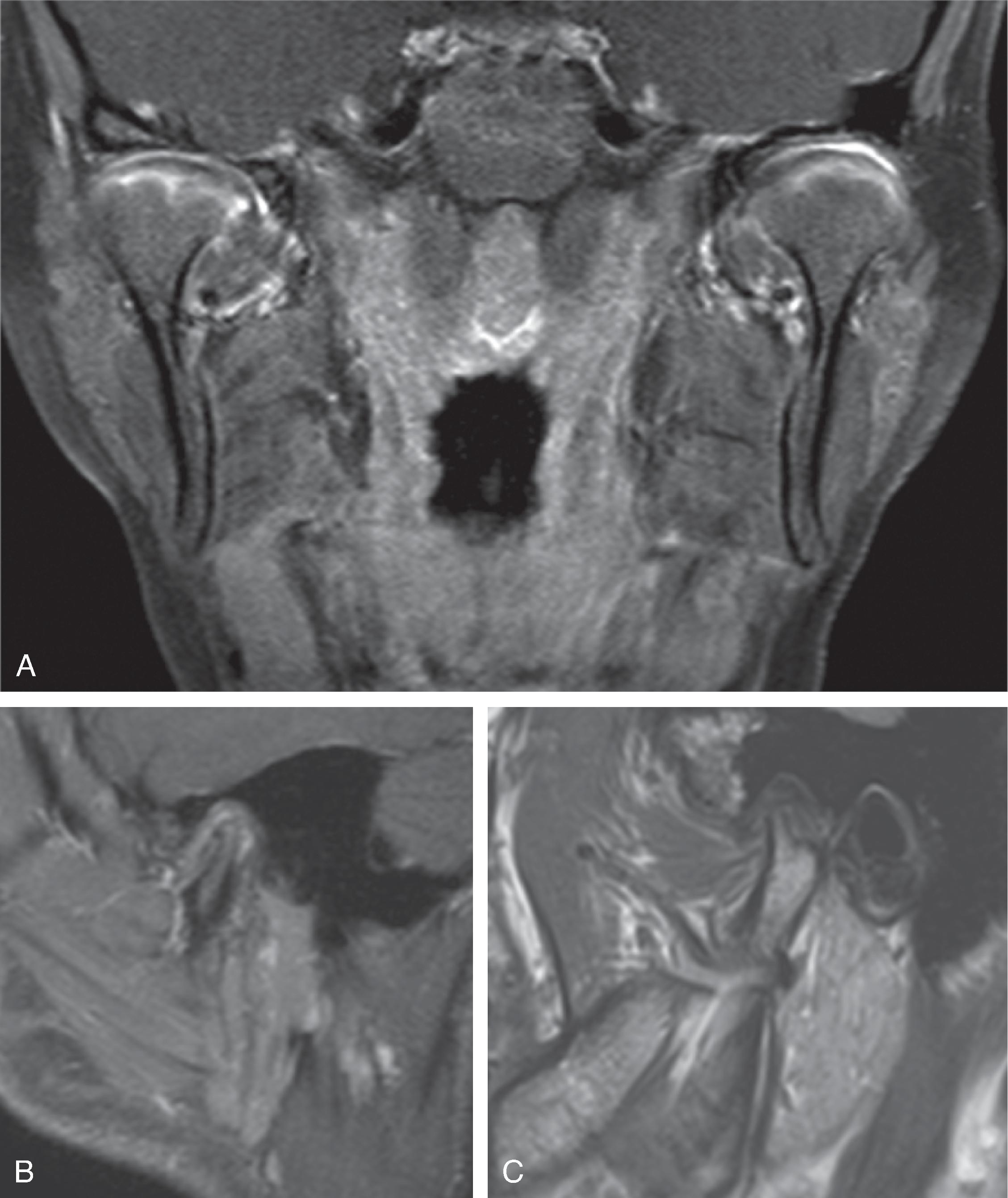 Fig. 15.40, Juvenile Idiopathic Arthritis.