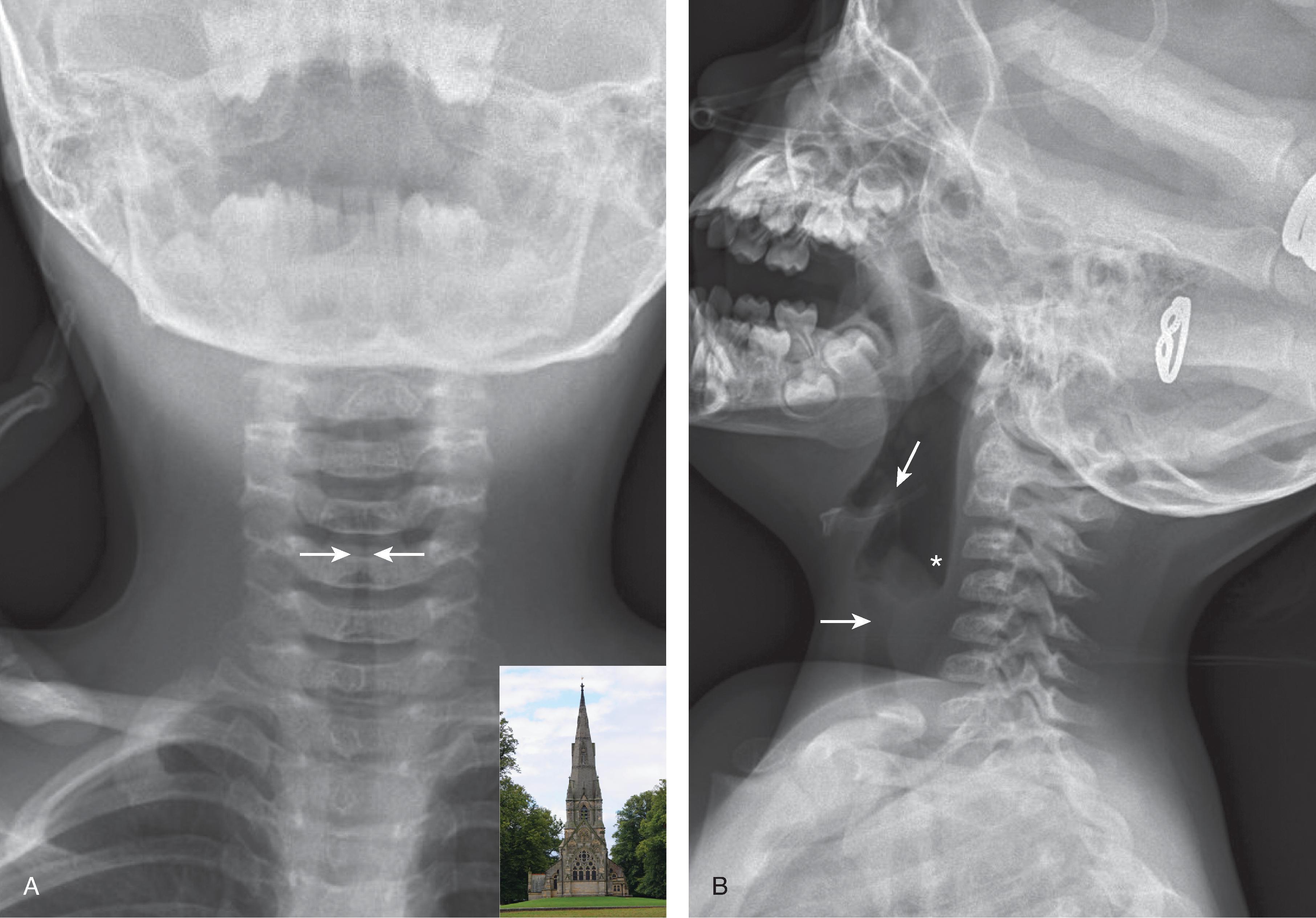 Fig. 15.8, Croup.