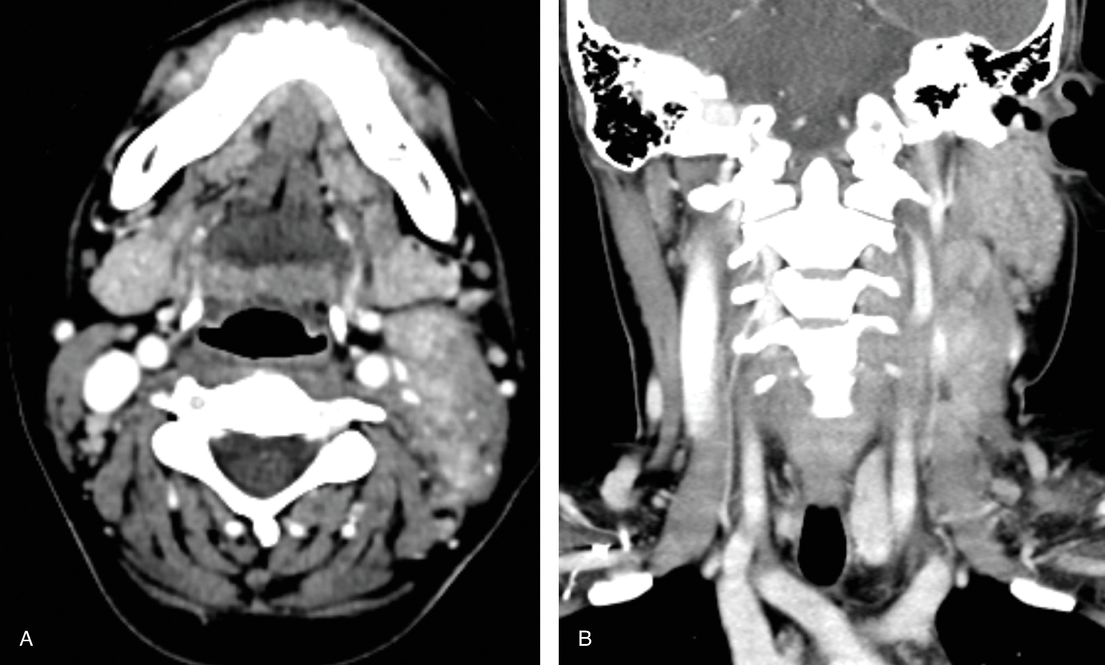 Fig. 15.4, Kikuchi Fujimoto Disease.