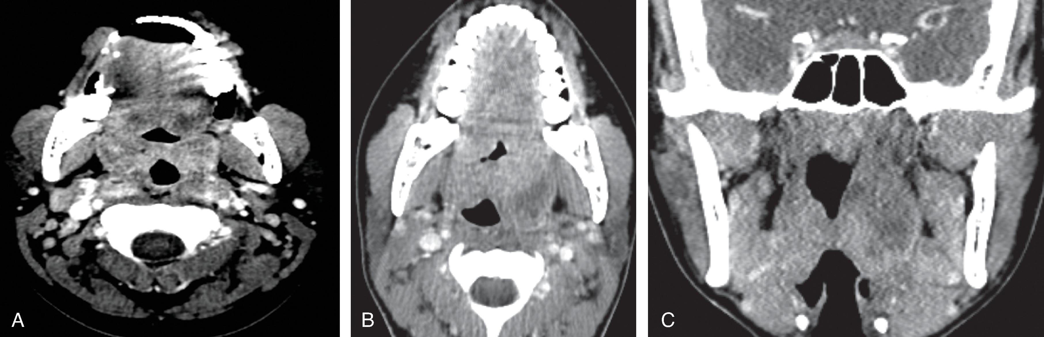 Fig. 15.5, Pharyngotonsillitis and Peritonsillar Abscess.