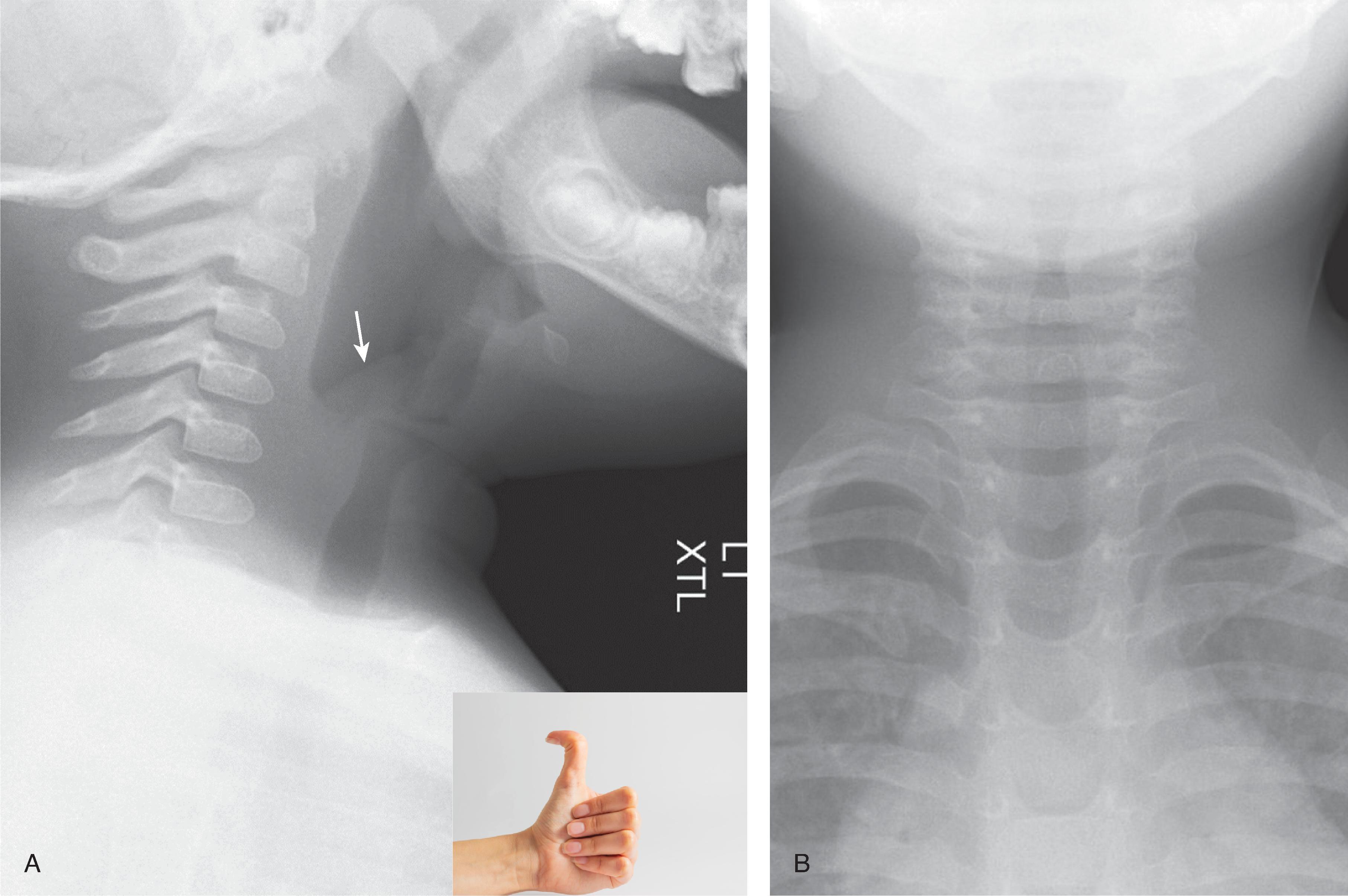 Fig. 15.9, Epiglottis.